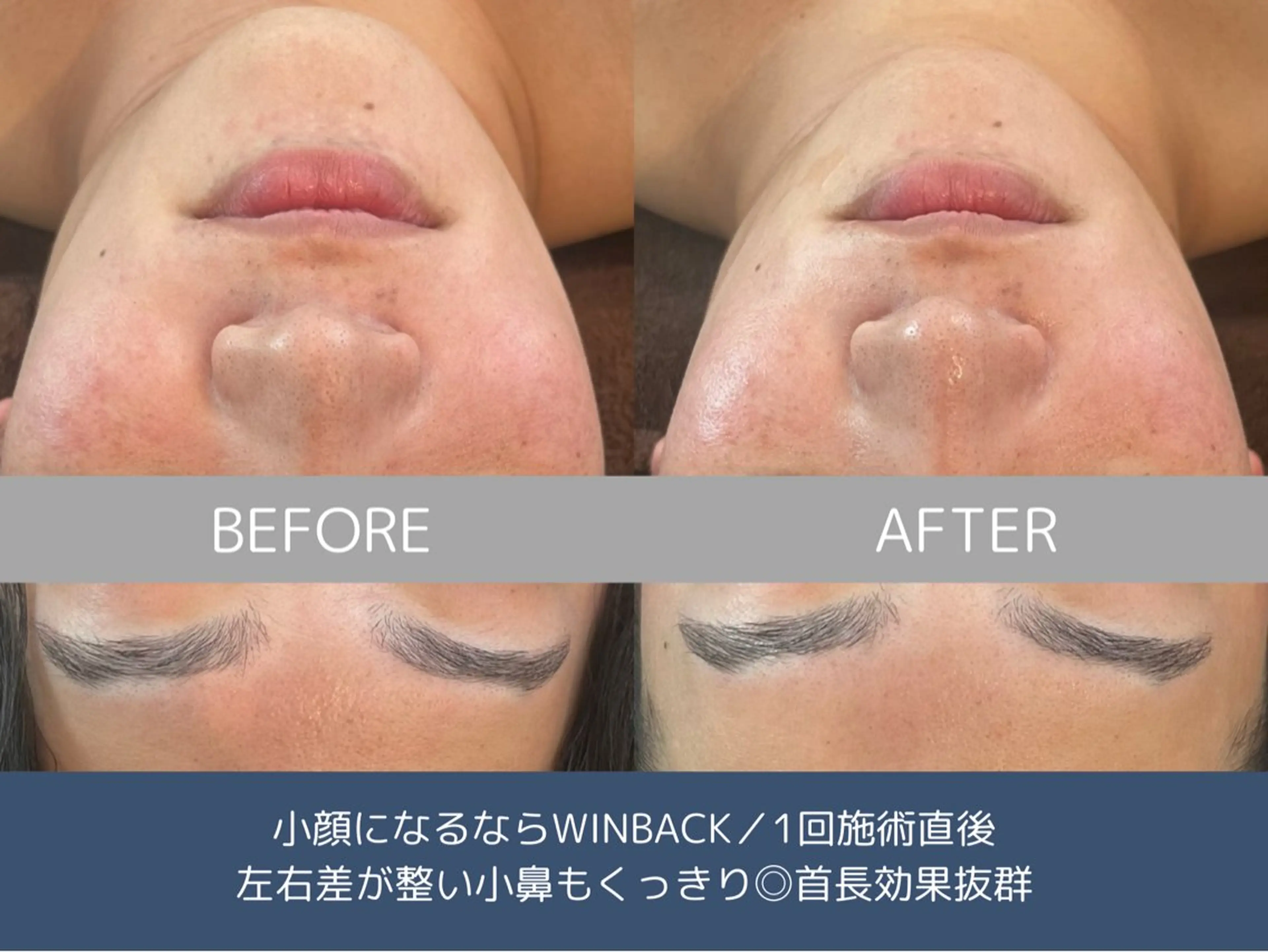 メンズ 艶肌ハーブピーリング /毛穴洗浄のエステ・リラクイメージ