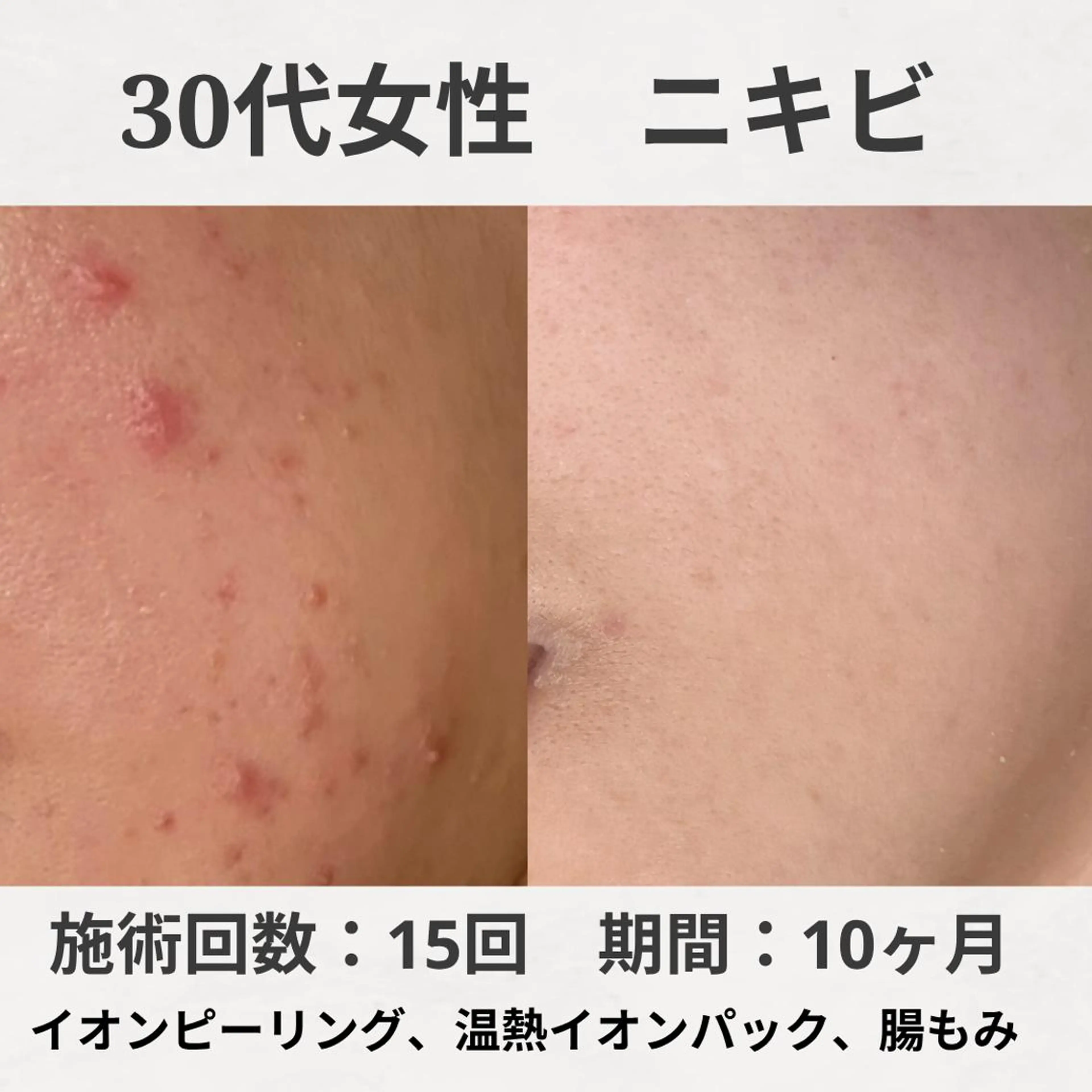 エステ リラク ニキビ跡改善専門🔥 医療にはできない改善のエステ・リラクイメージ