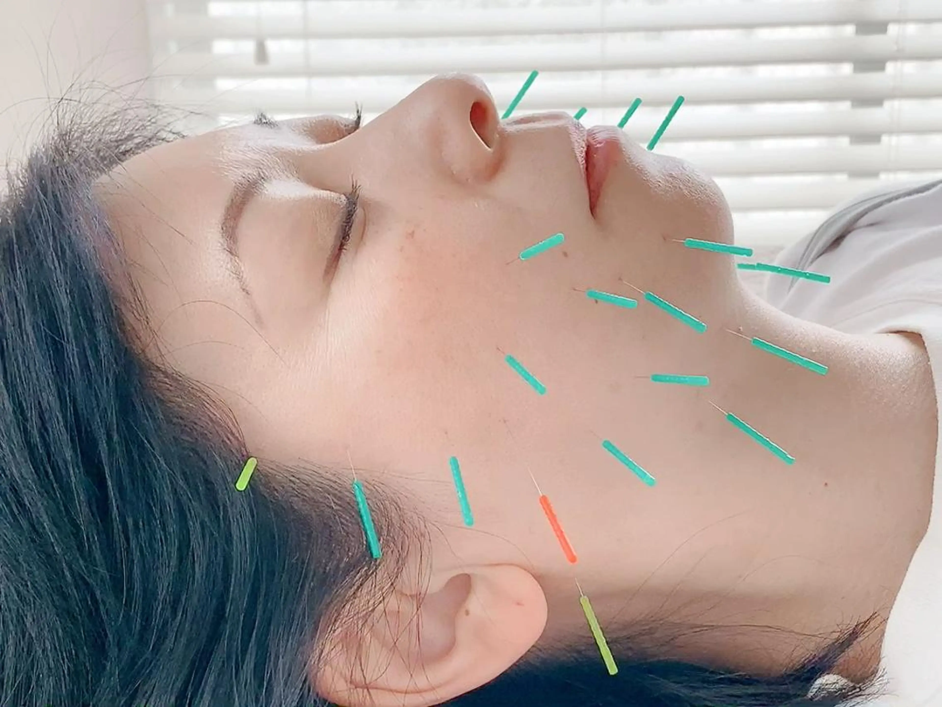 印象の良くなる 美容鍼のエステ・リラクイメージ