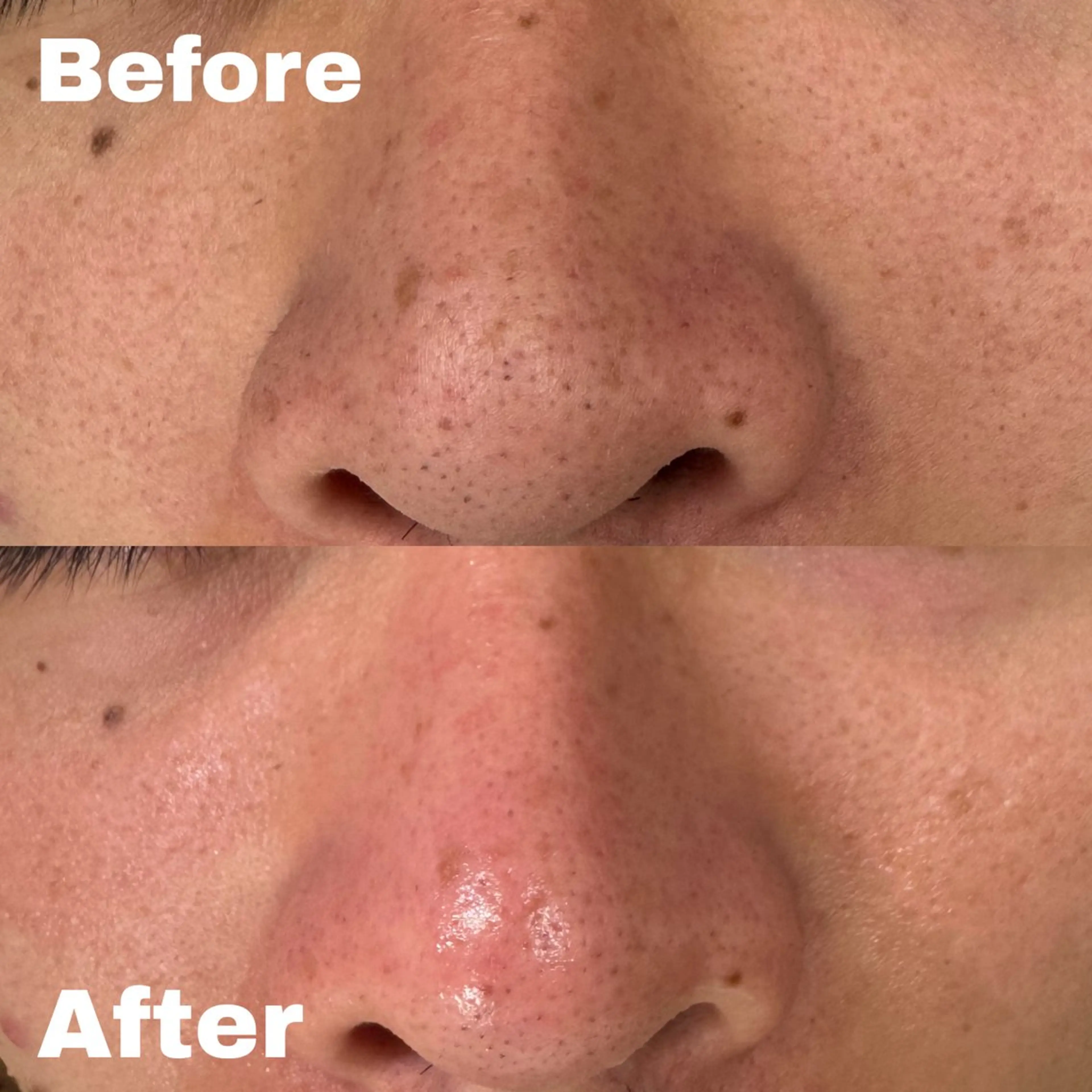 【毛穴撃退】クイック毛穴洗浄＋お顔のむくみ&たるみケアコースの写真