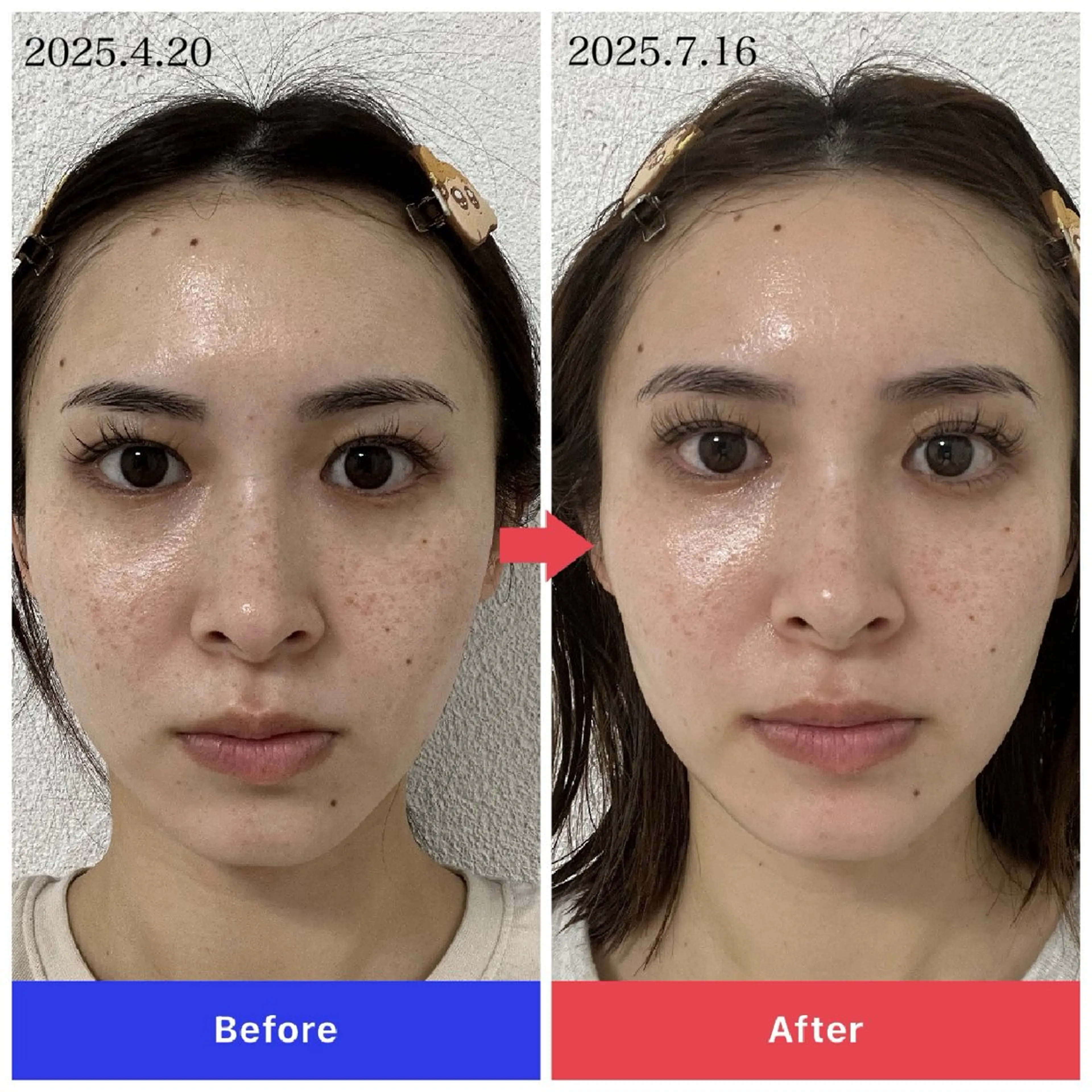 【本気の美肌再生】プラズマスキンの写真