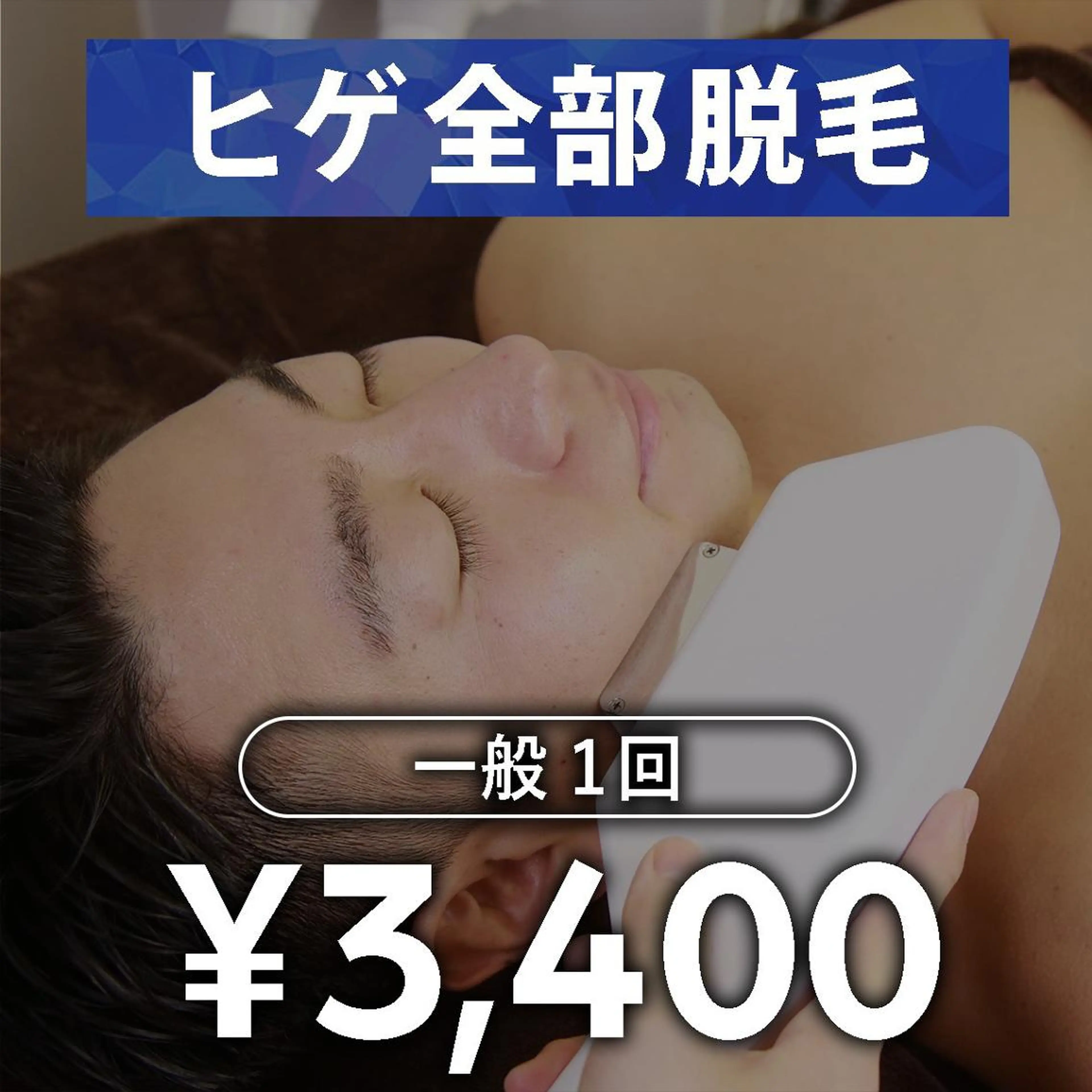 【メンズ脱毛】ヒゲ脱毛 1回の写真