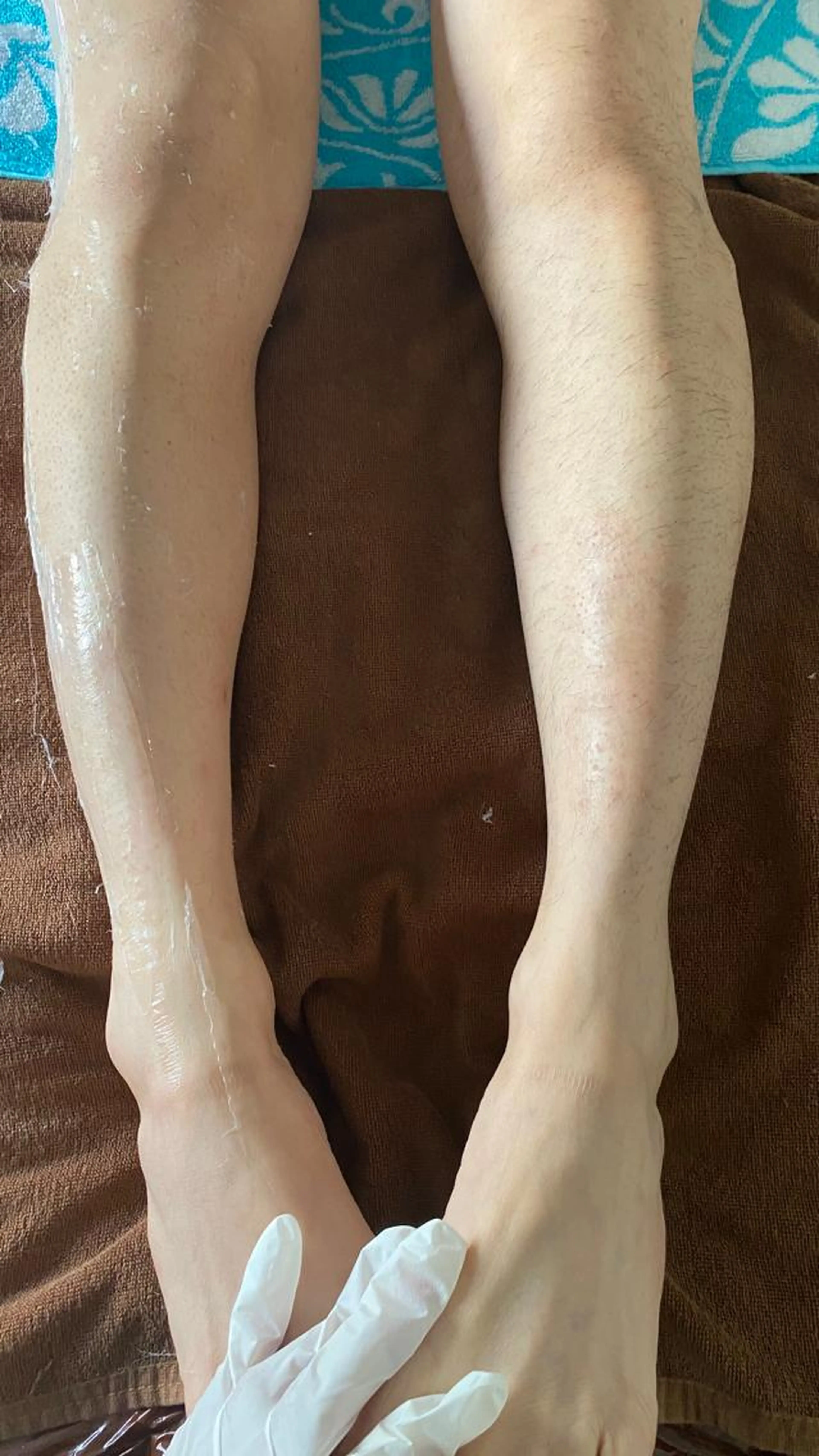 効果も安心感も◎痛みの少ないVIO光脱毛でつるん肌に！の写真