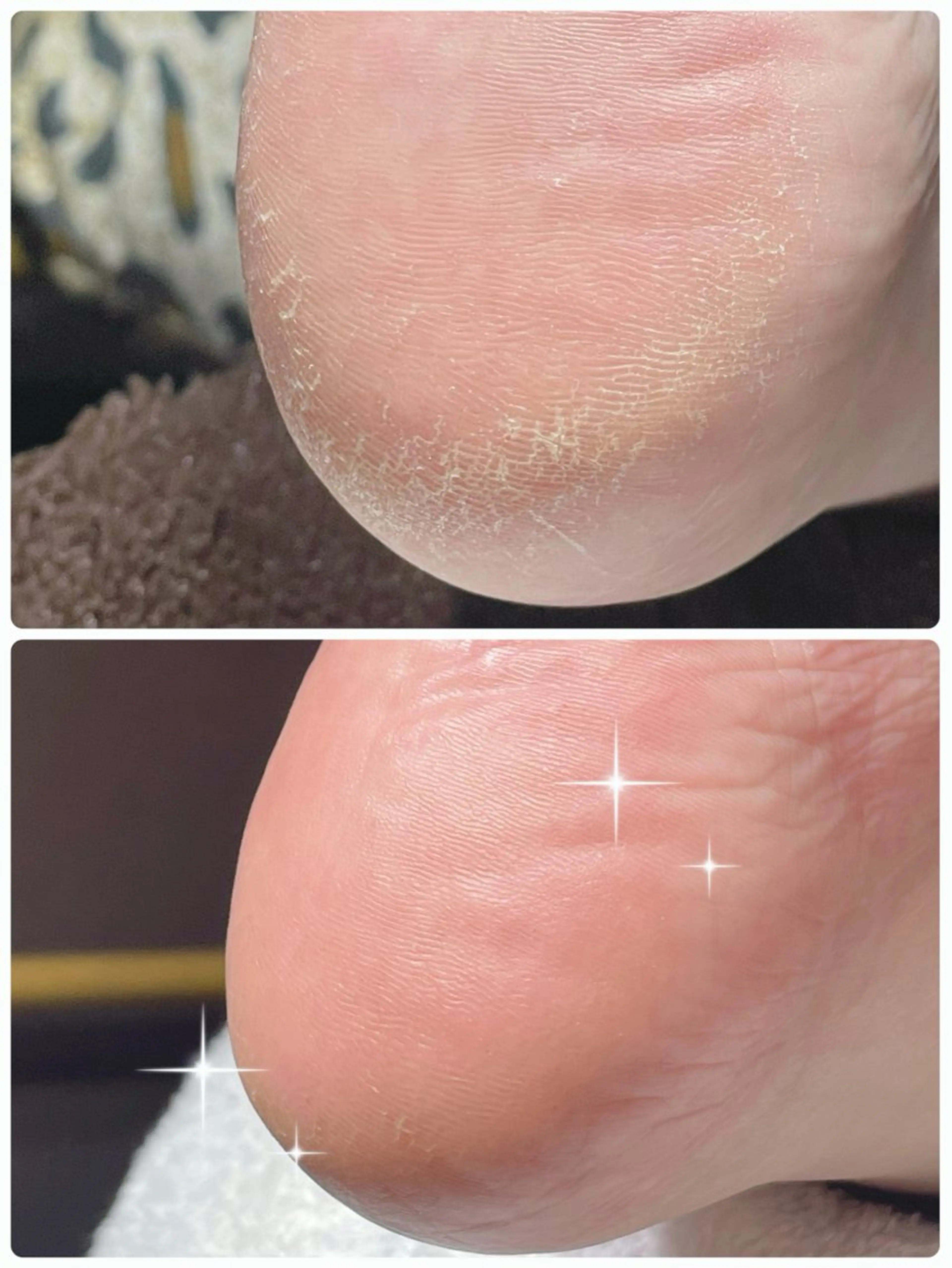 かかと角質除去の写真