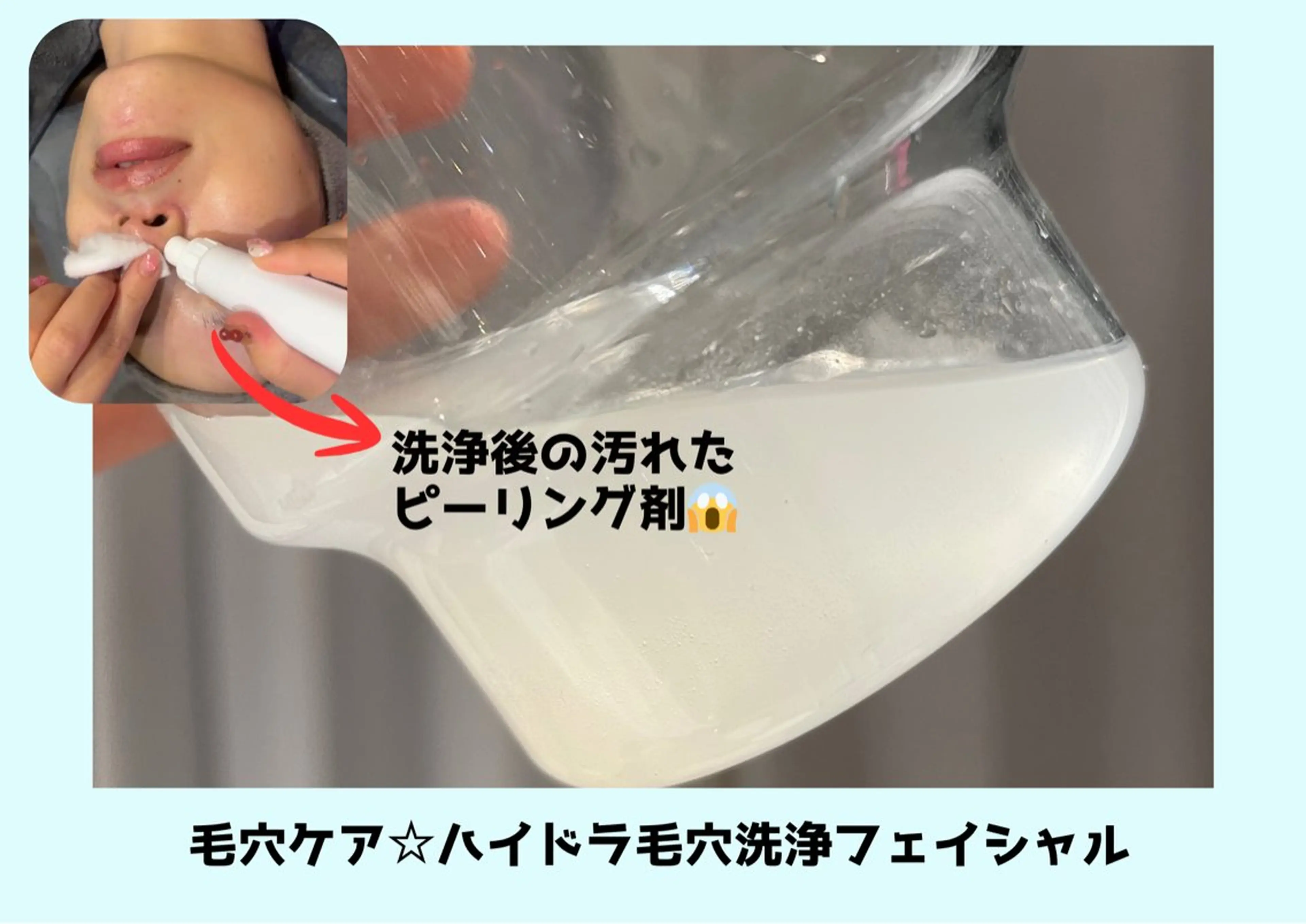 【ずっと同価格】ハイドラ毛穴洗浄✨　毛穴つまり/黒ずみを徹底ケア！　¥3000の写真