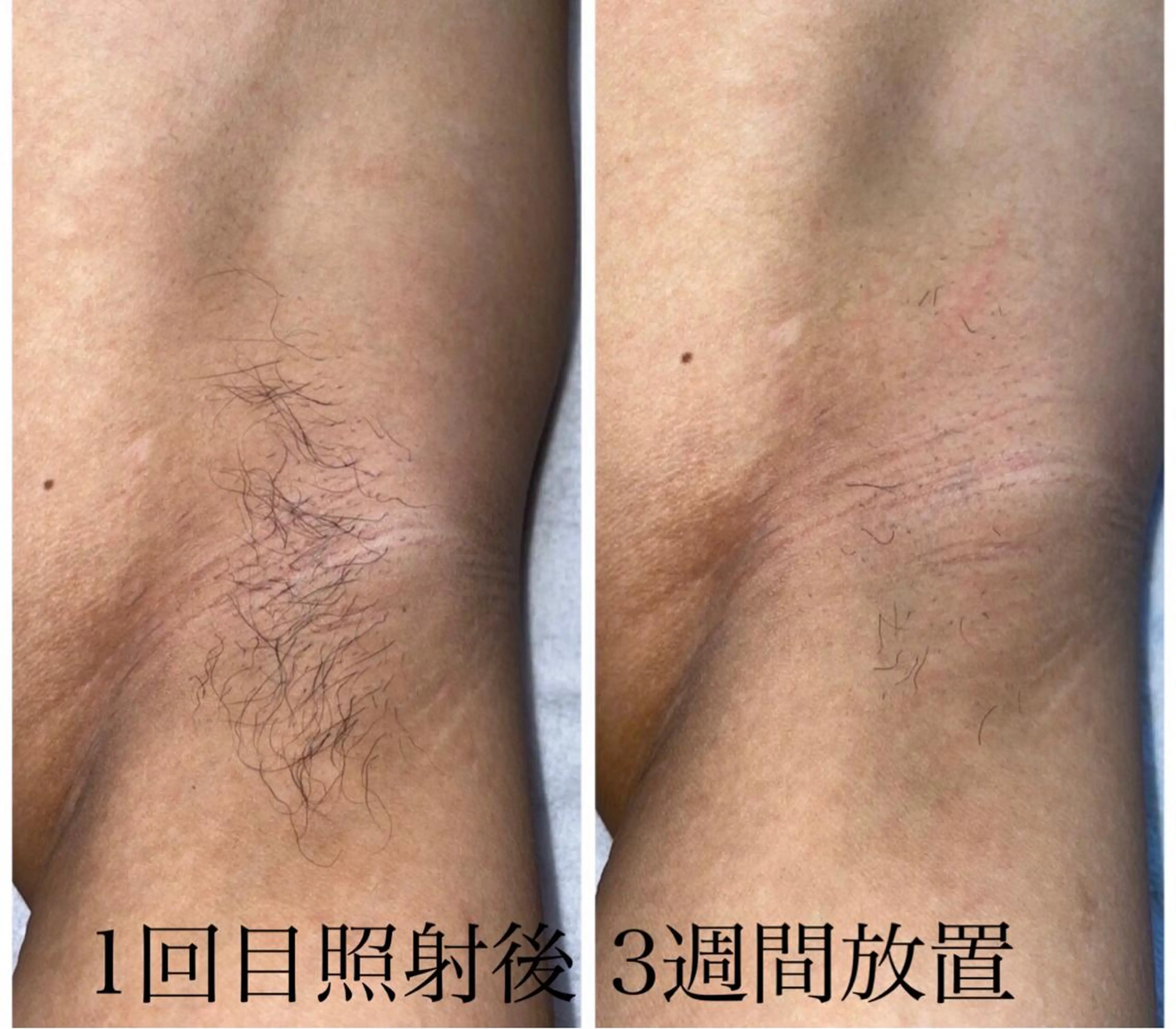 メンズ ecia 脱毛/豊田/浄水のエステ・リラクイメージ