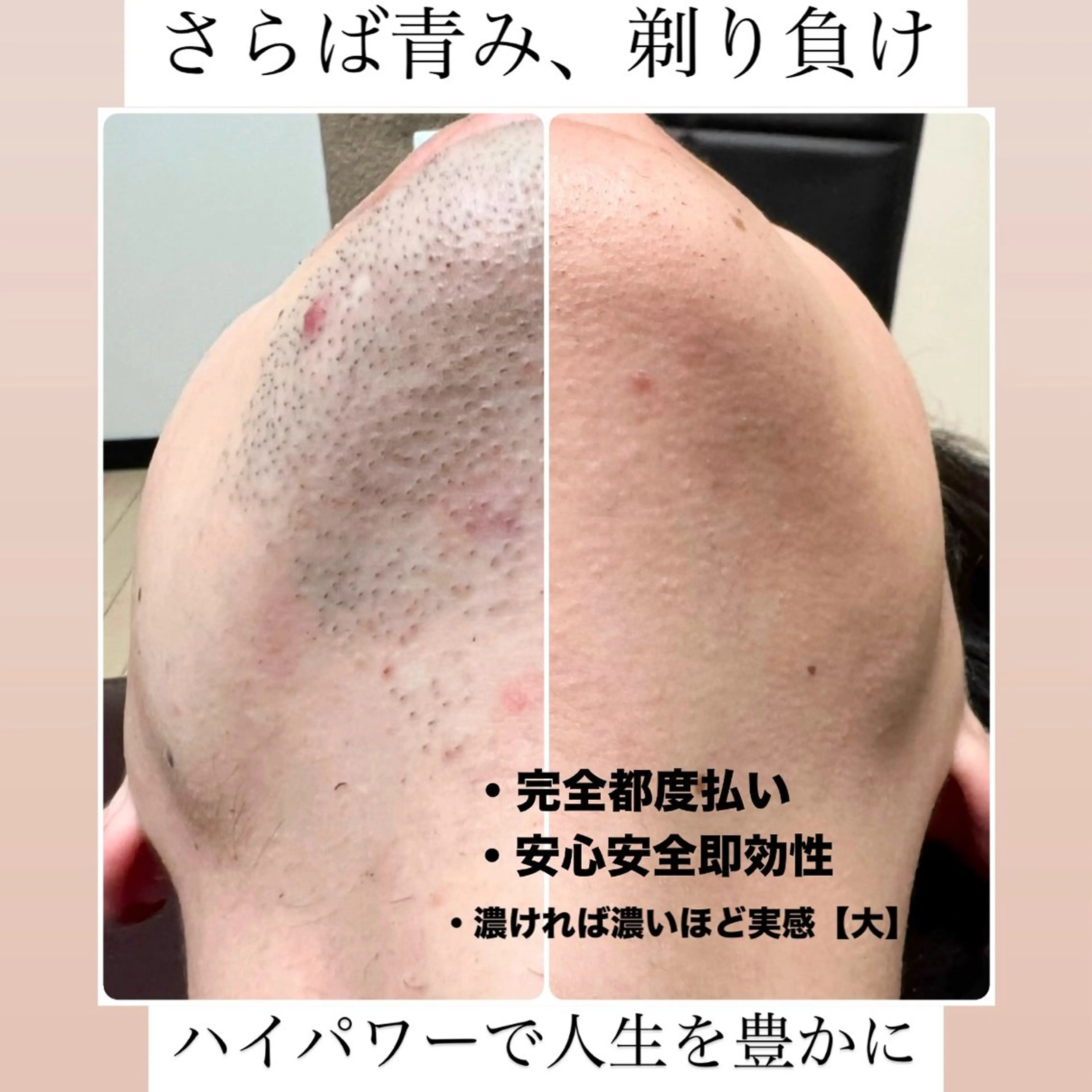 メンズ 脱毛 メンズ脱毛サロン Le falcoのエステ・リラクイメージ