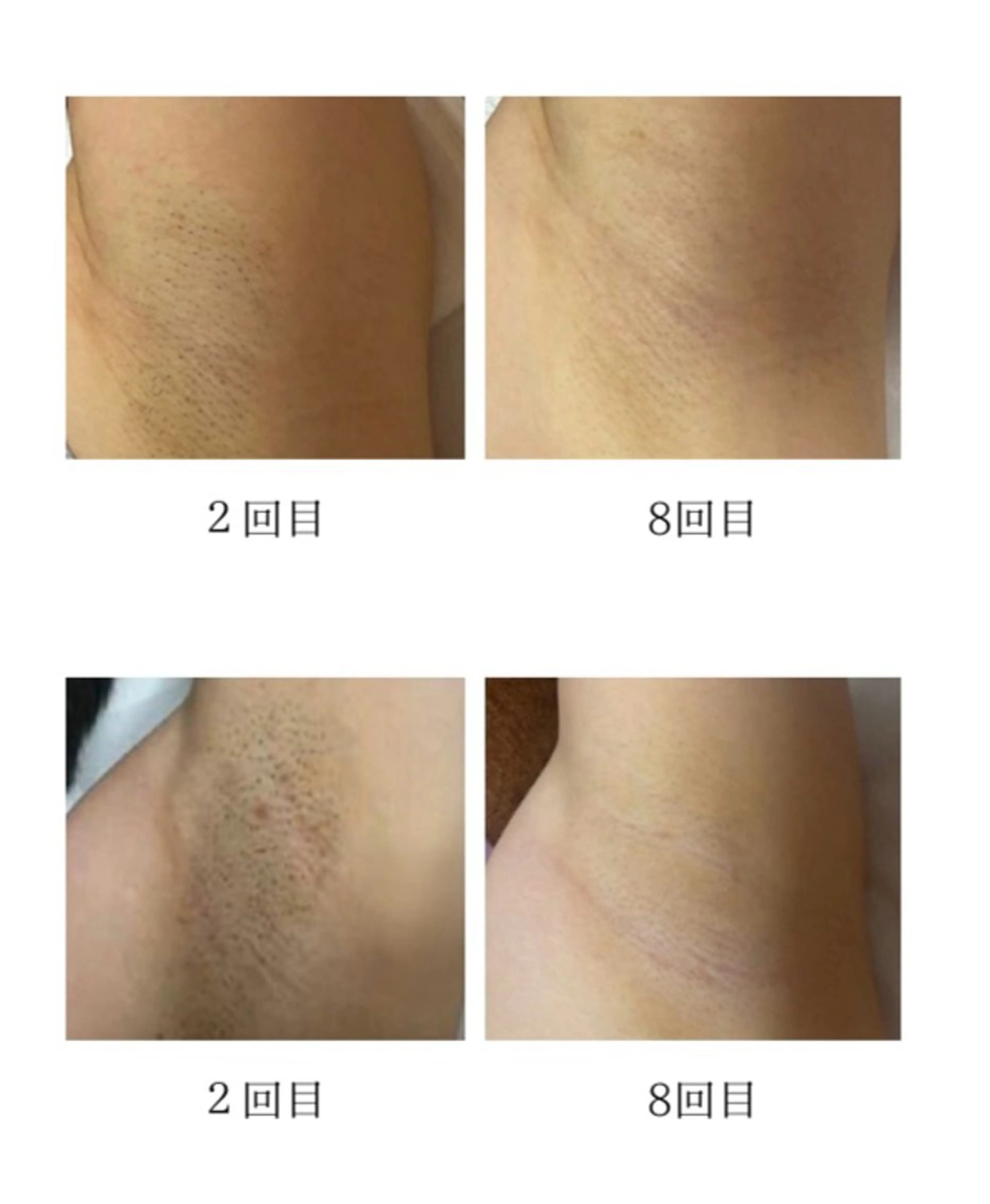 脱毛 EstheticSalonReTweet所属・Esthetic ReTweetのエステ・リラクイメージ