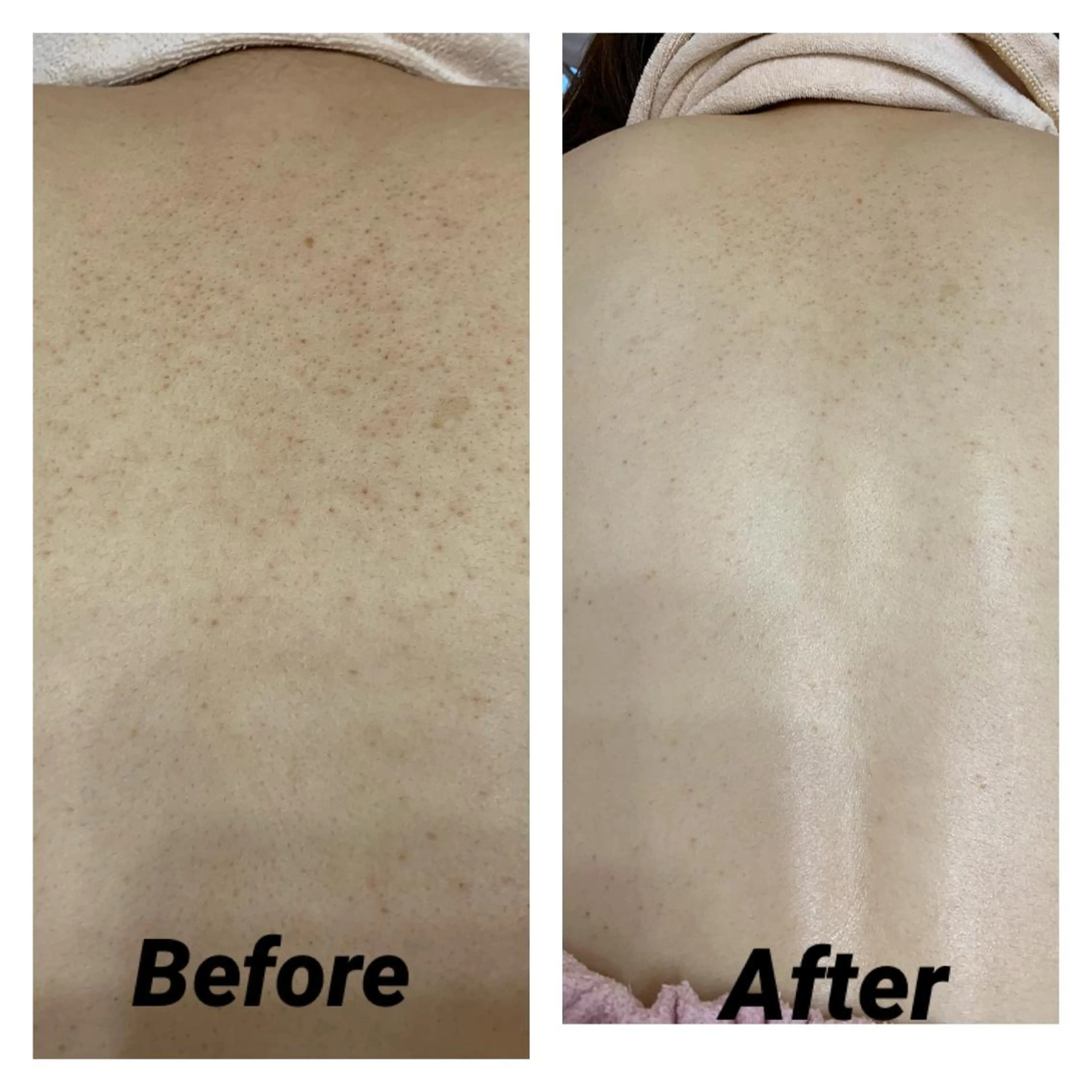 【背中ニキビケア.ザラつき改善ピーリングコース】お背中マッサージ付❣️の写真