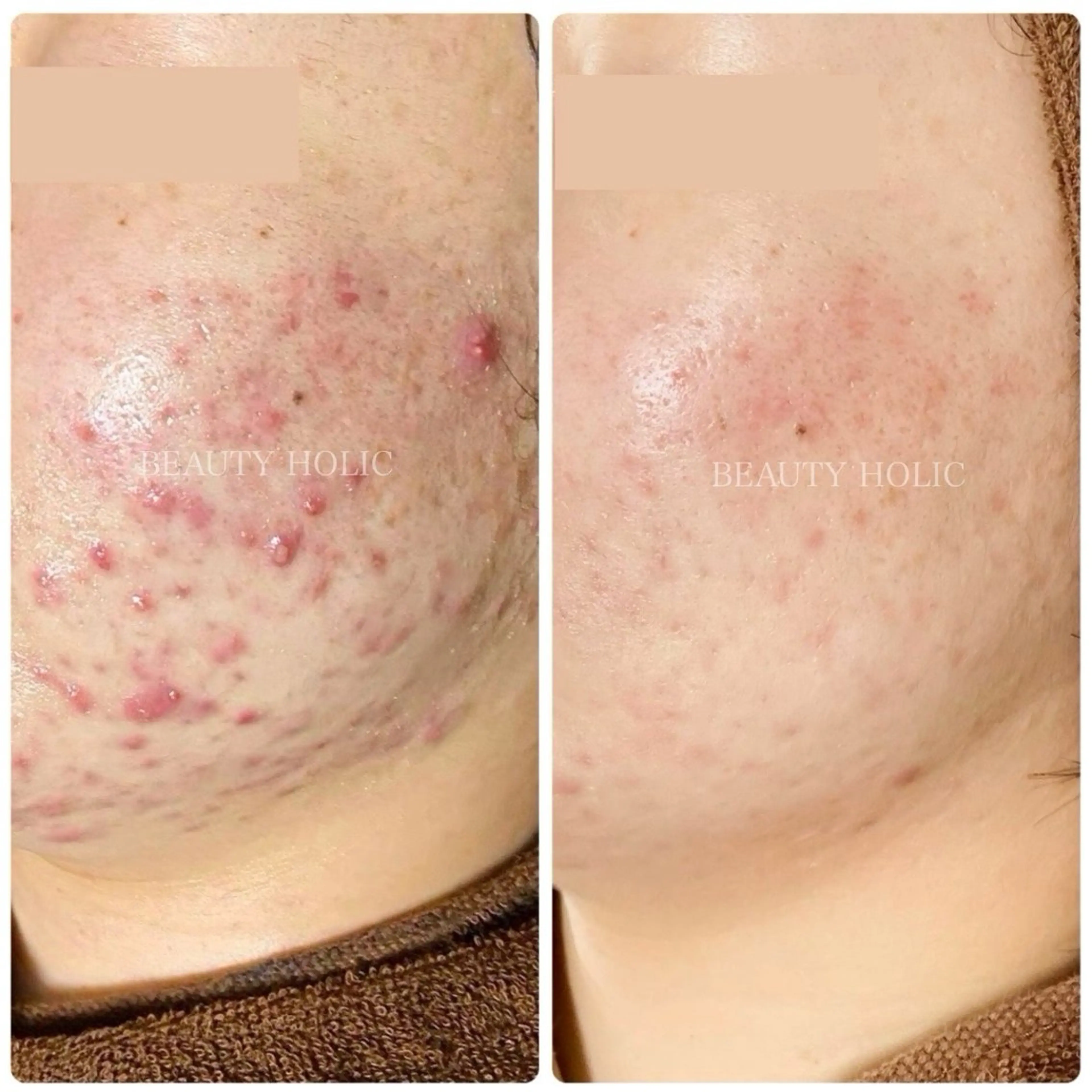 エステ ニキビ・ 肌荒れ専門店のエステ・リラクイメージ