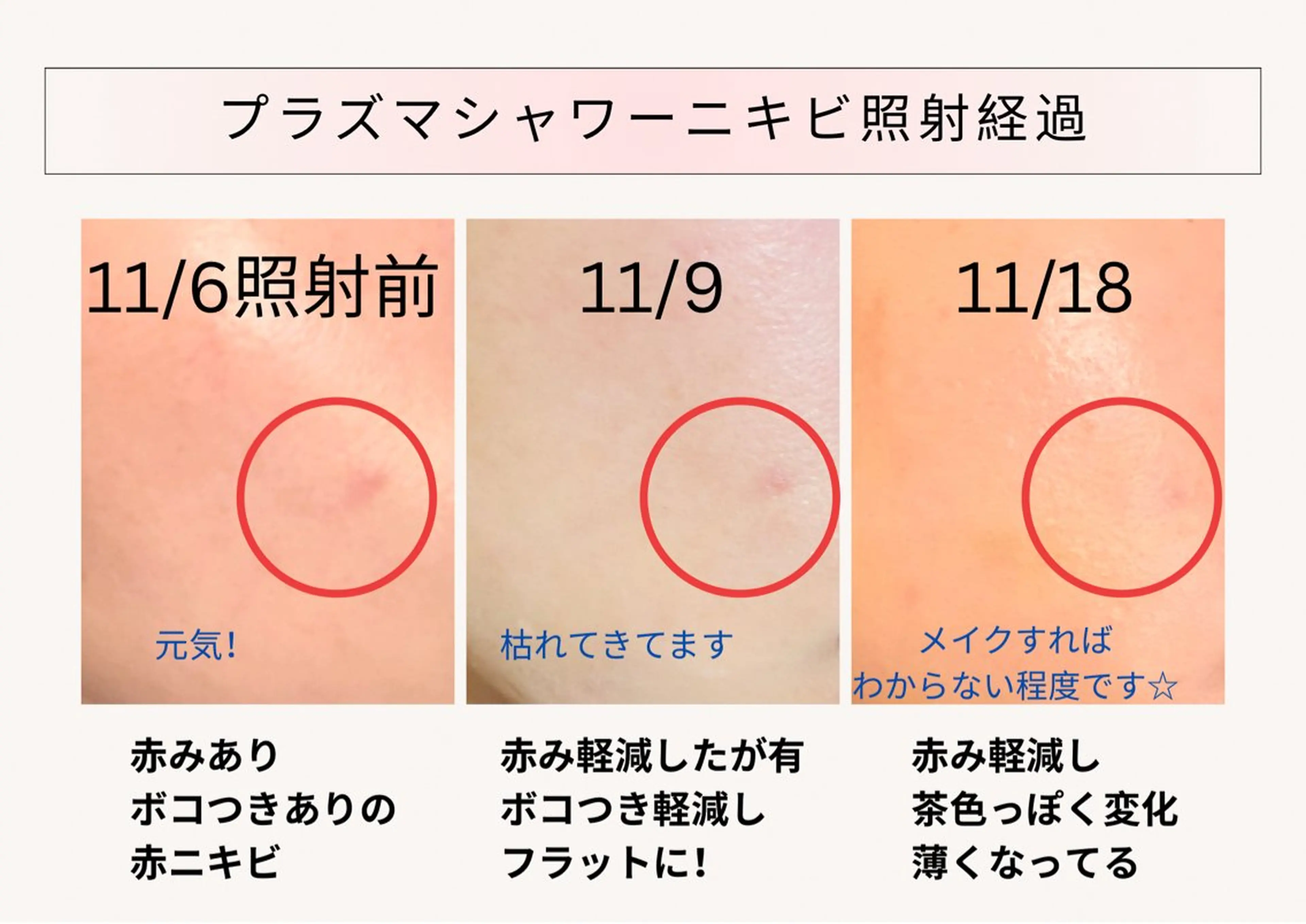 エステ 小顔&毛穴・肌質改善 LINDA西宮 AIのエステ・リラクイメージ