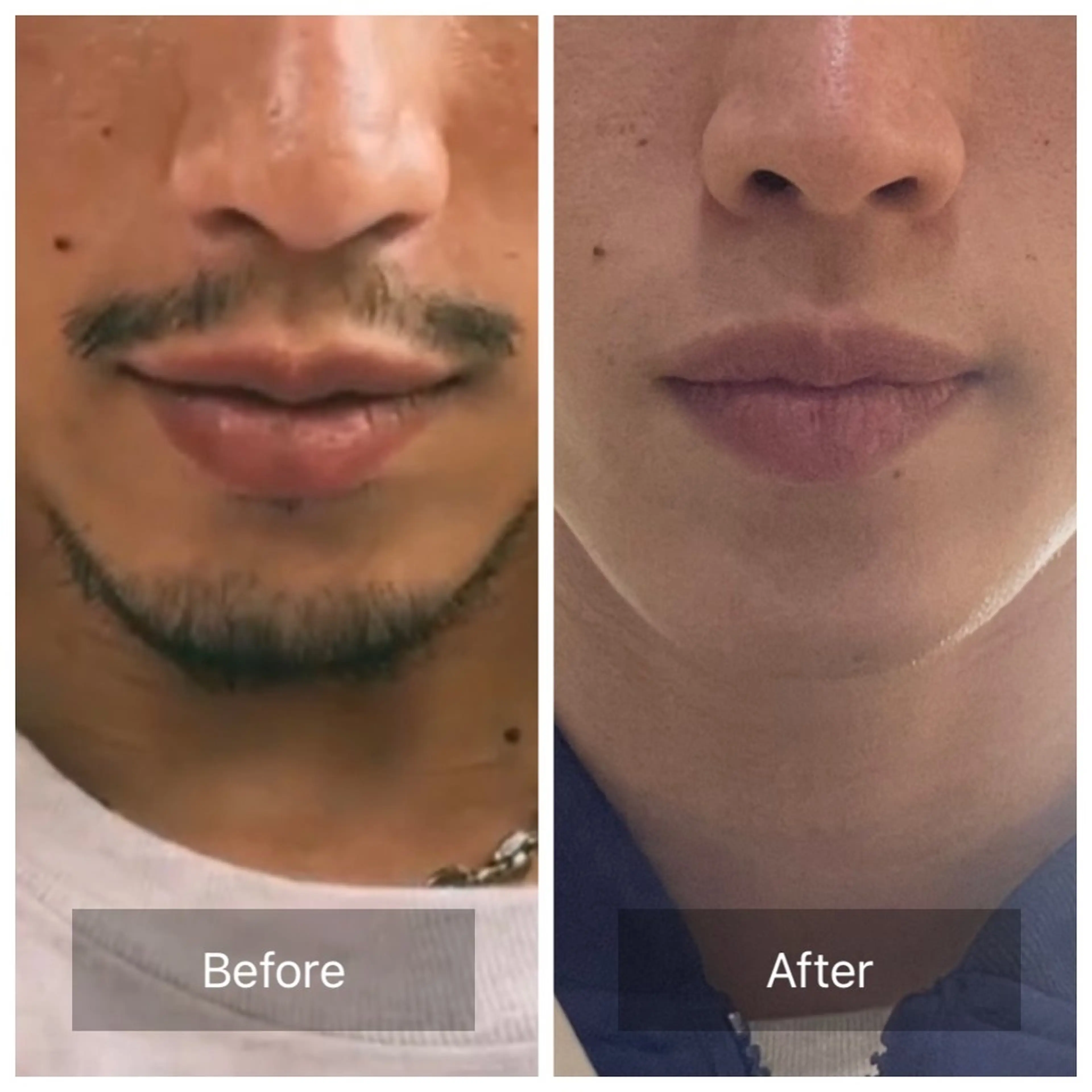 【プラチナビーム脱毛】髭脱毛1回（メンズ）の写真