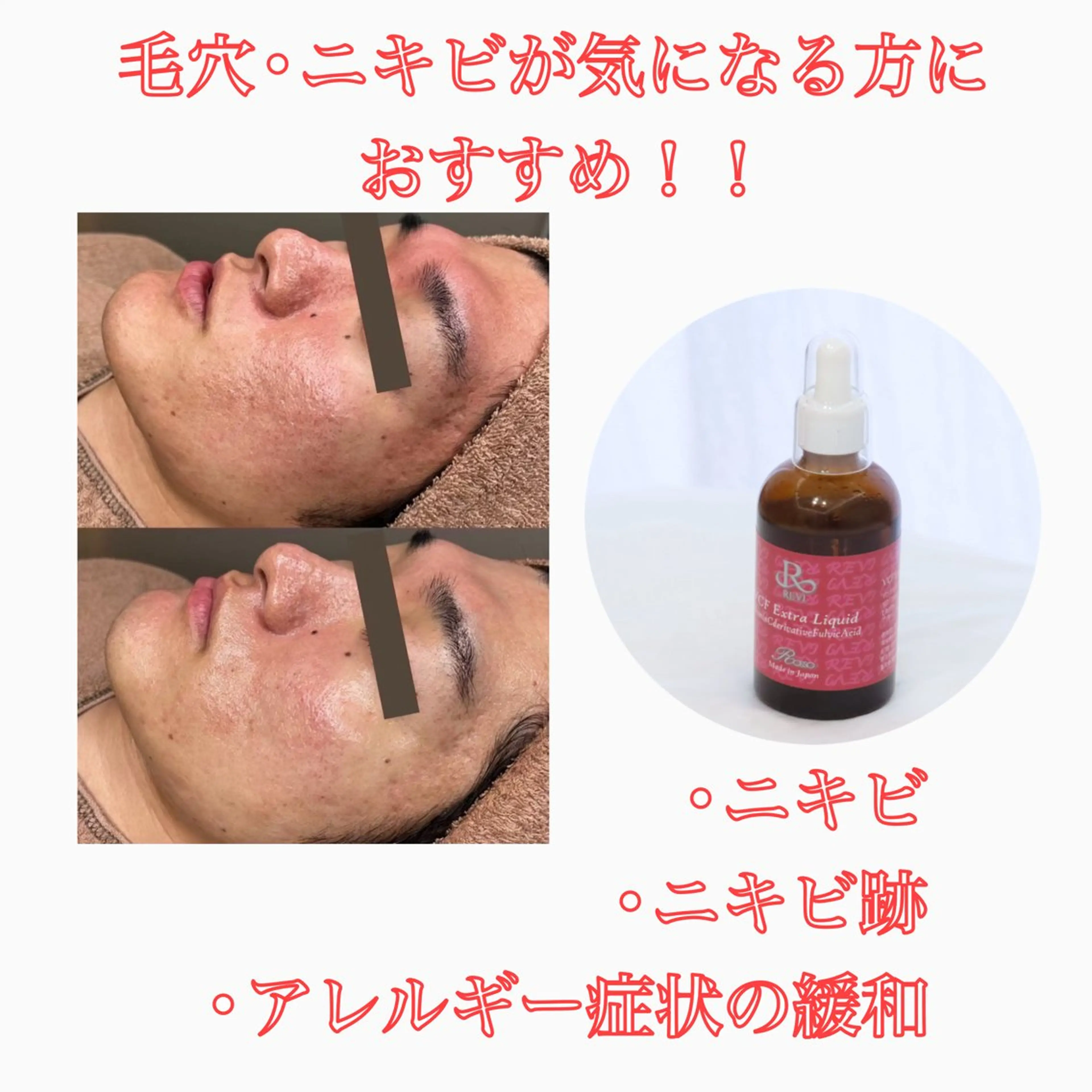 🌿REVIハーブピーリング🌿➕【高濃度ビタミンC美容液】の写真