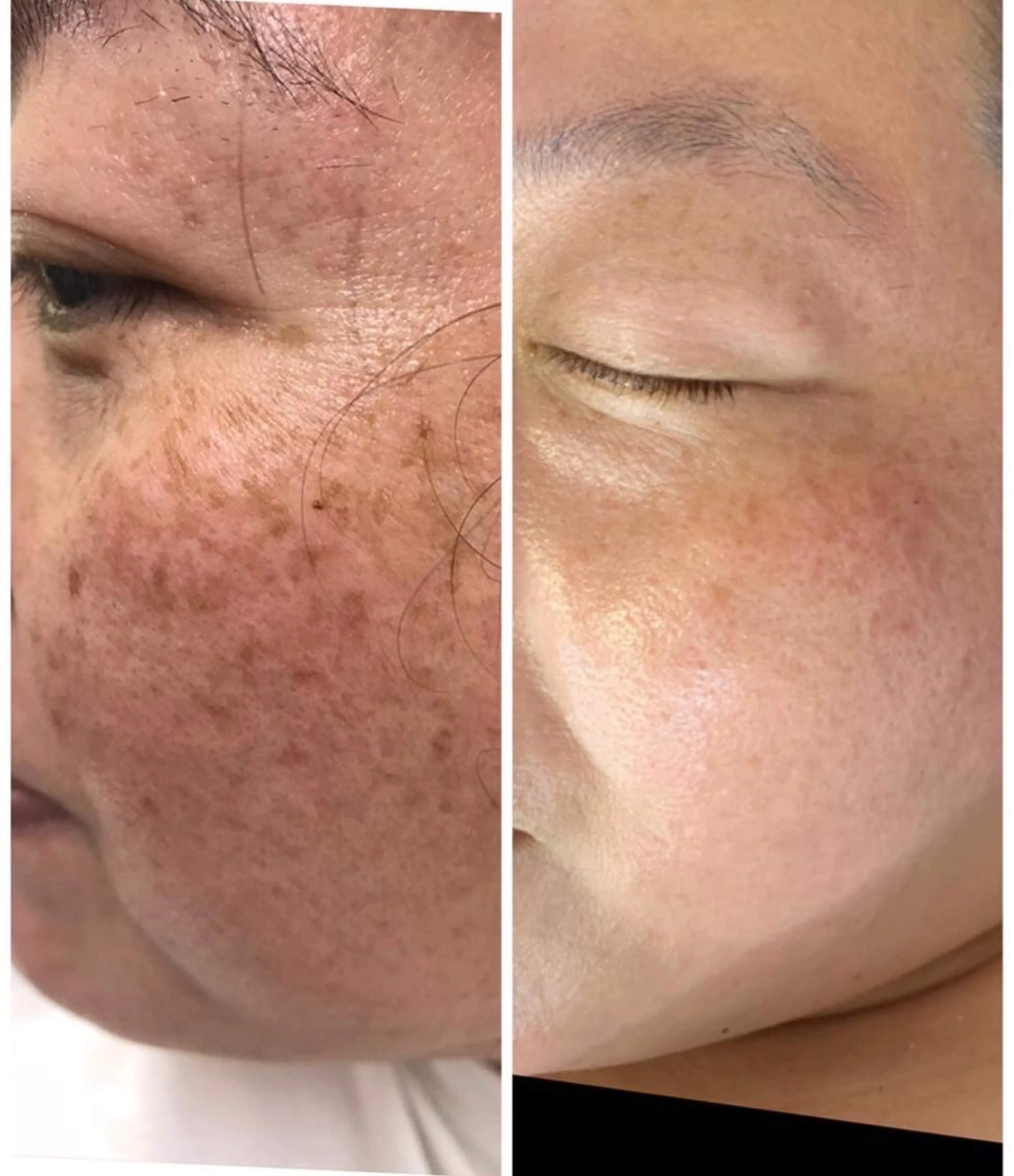 シルククレンジング＆純高濃度ヒト幹細胞エステの写真