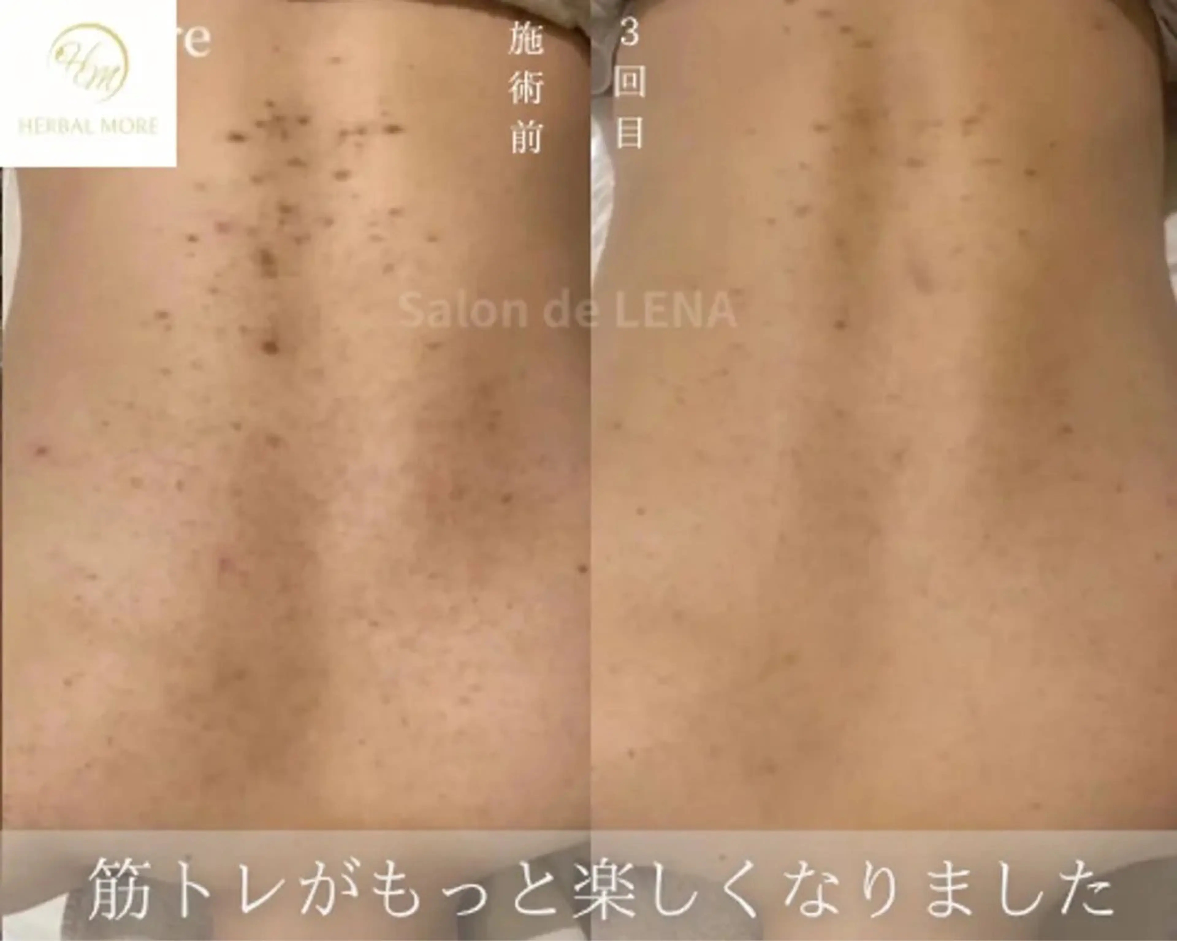 【背中ハーブピーリング/剥離有•無】ニキビケア、色素◯着、毛穴、サメ肌、ニキビあとの写真