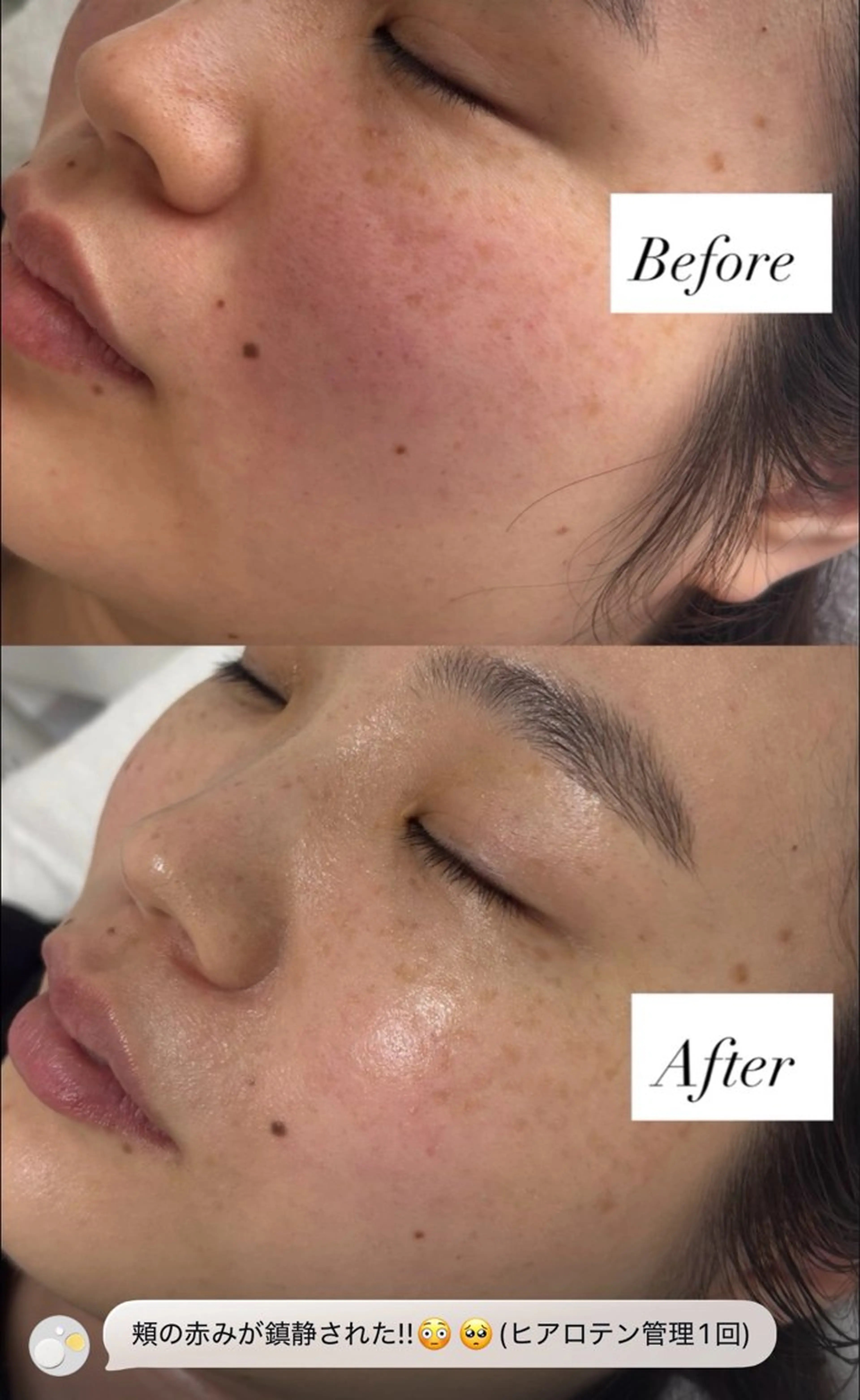 Hilluin大曽根 韓国肌管理のエステ・リラクイメージ