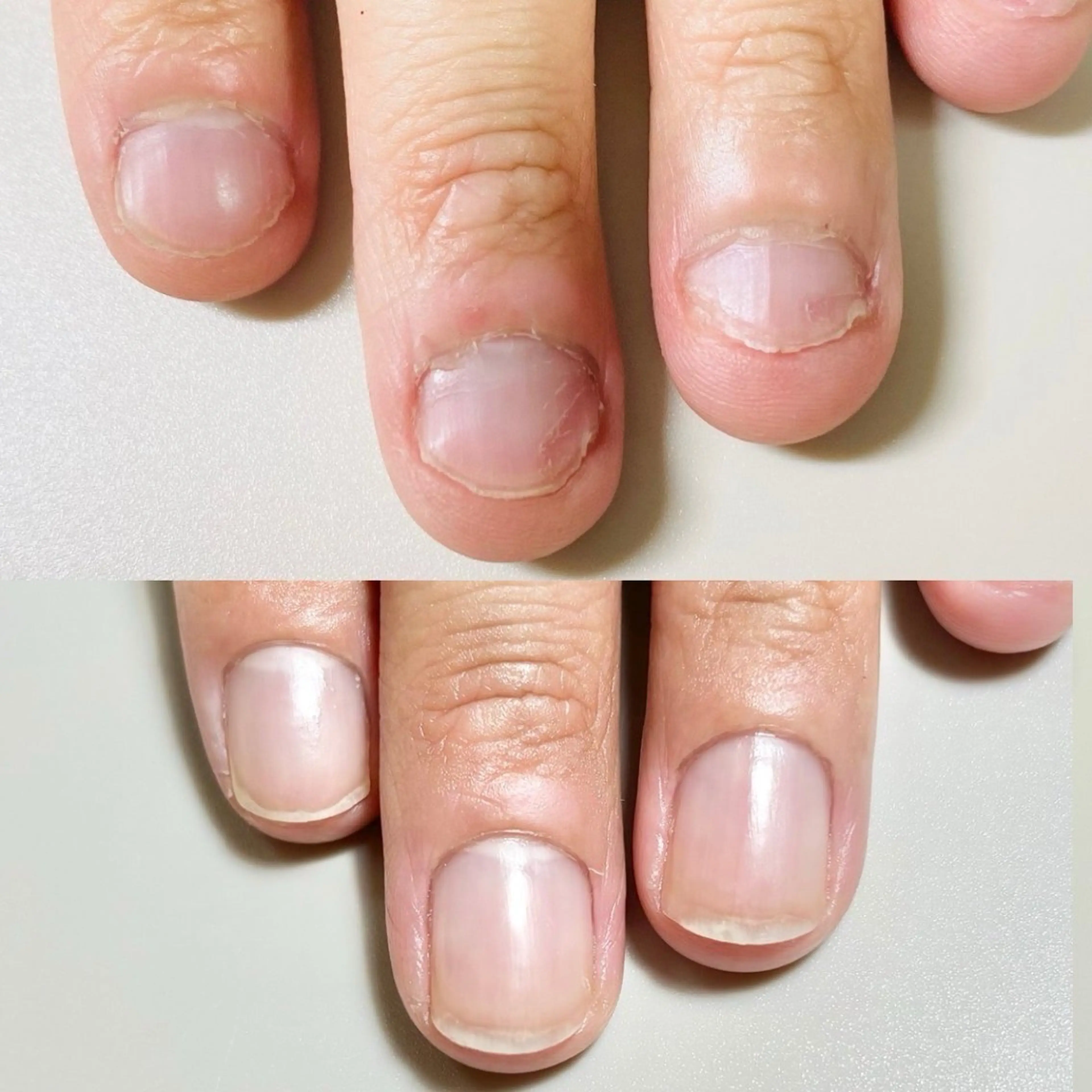 深爪矯正　幼い頃からの噛み癖やむしり癖による深爪を縦長爪へ。オイル1本プレゼントの写真