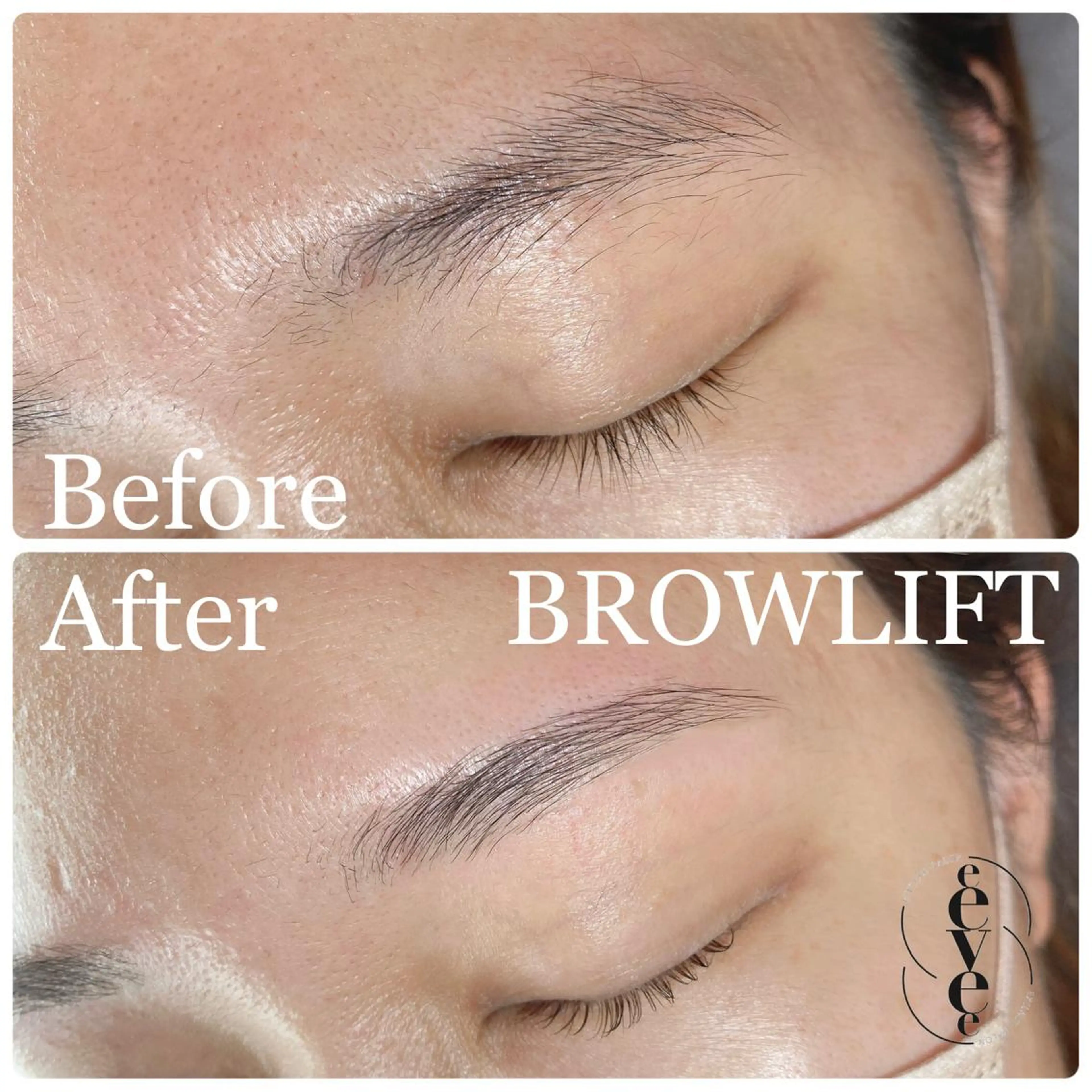 ブロウリフトの写真