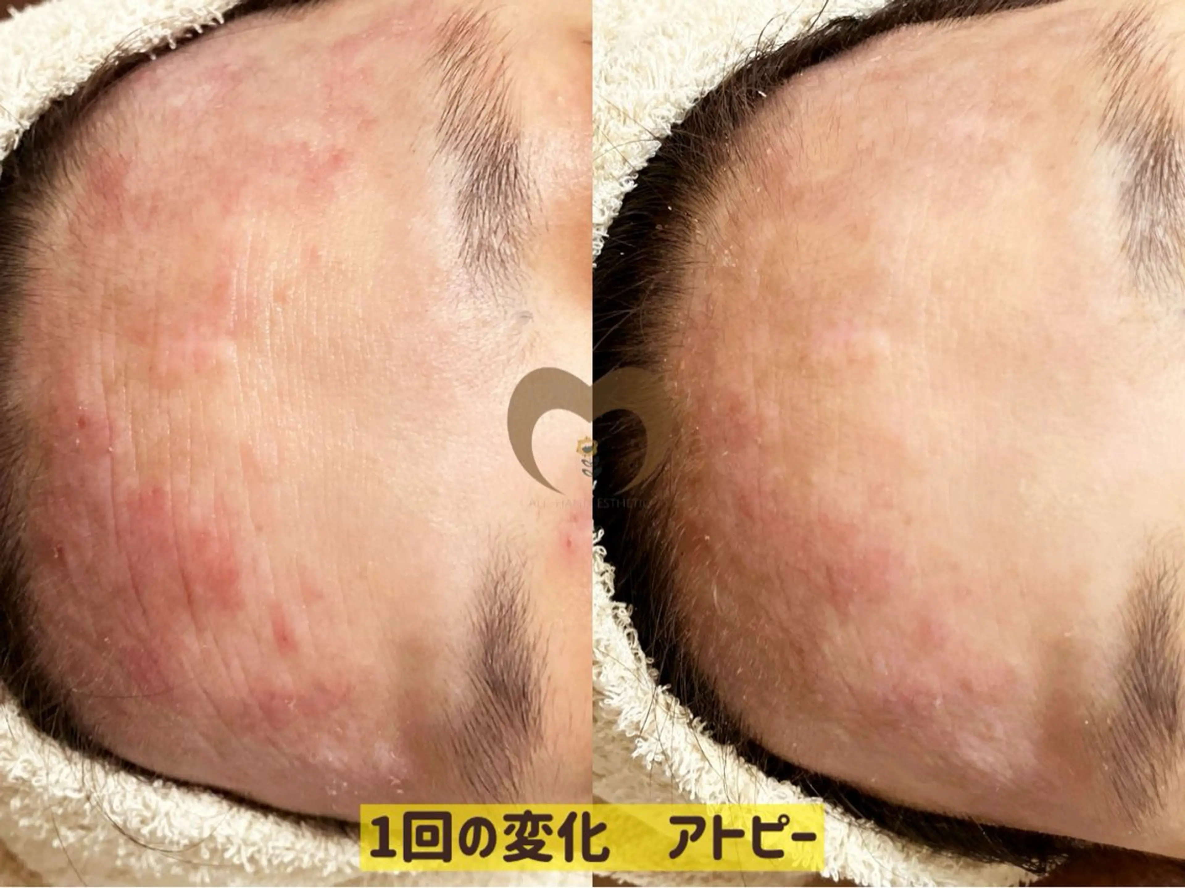 エステ リラク 繰り返すニキビ・毛穴 ✨つくば肌質改善専門のエステ・リラクイメージ