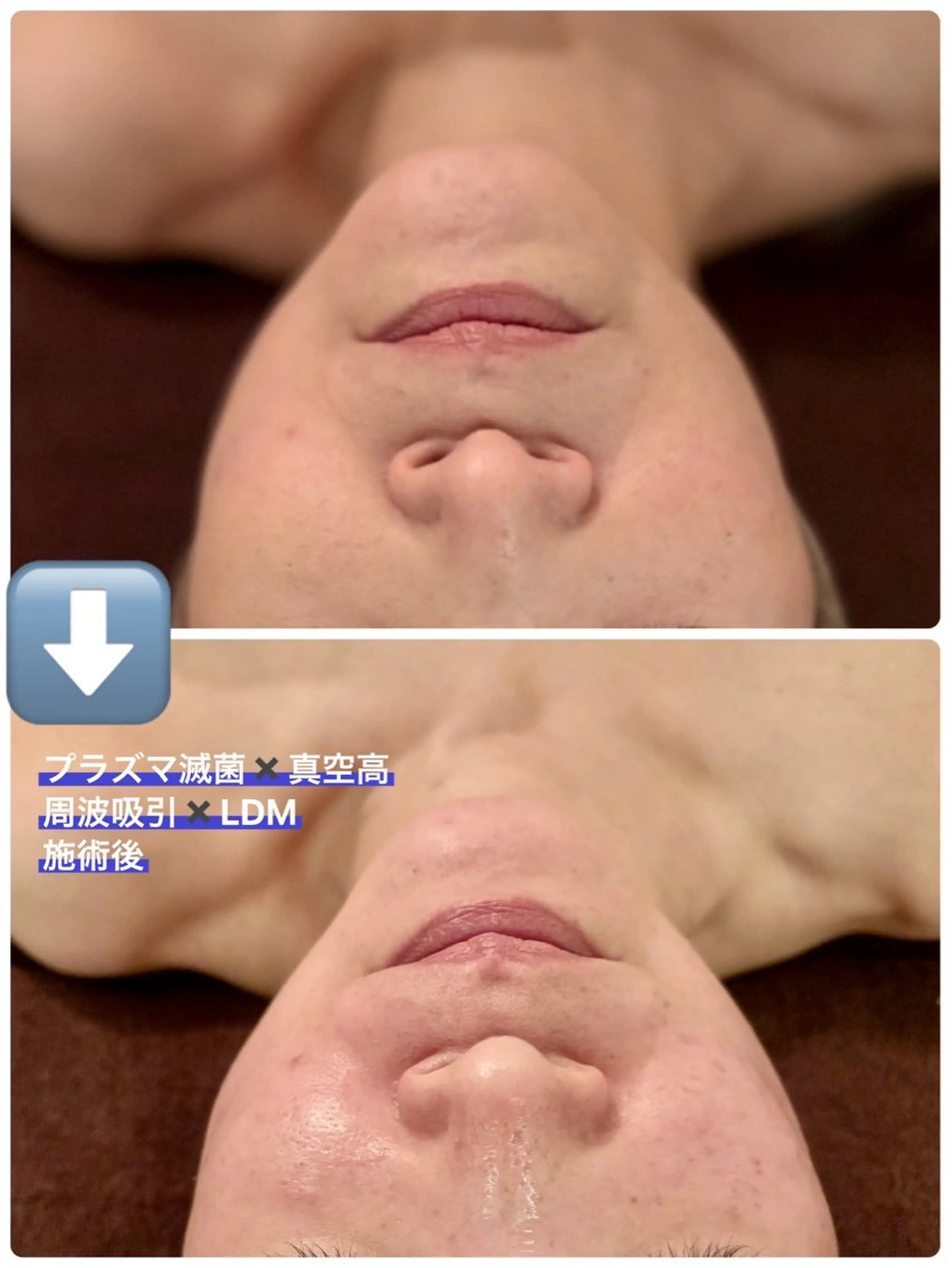 美肌小顔✨プラズマ滅菌✖️真空吸引✖️LDM水玉リフティングのスペシャルコース✨お悩みに合わせた美容液導入付き💗の写真
