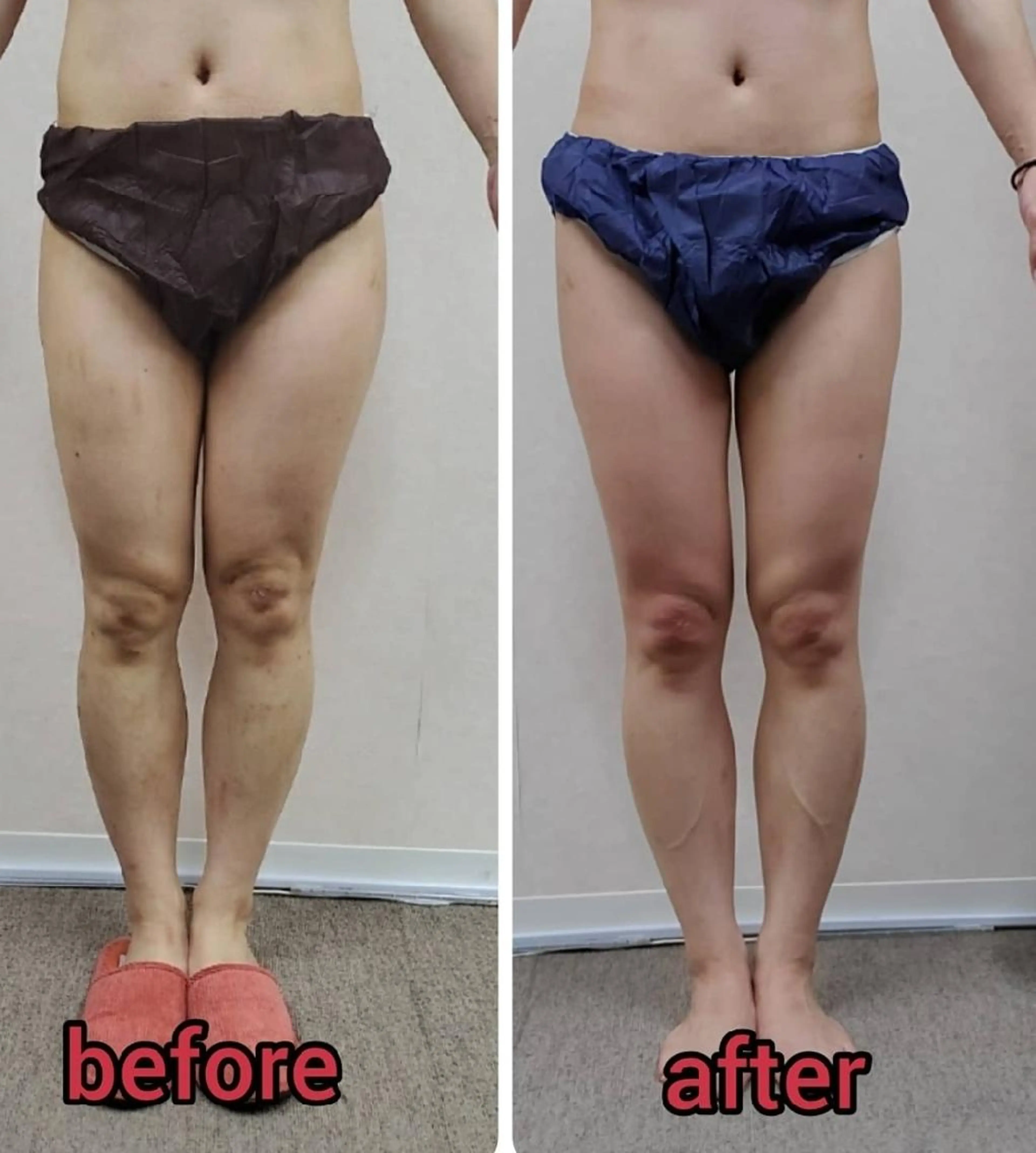 【痩身】特許取得のWキャビテーション＆超音波で脂肪が溶けて流れて更に筋肉を引き締めます！の写真