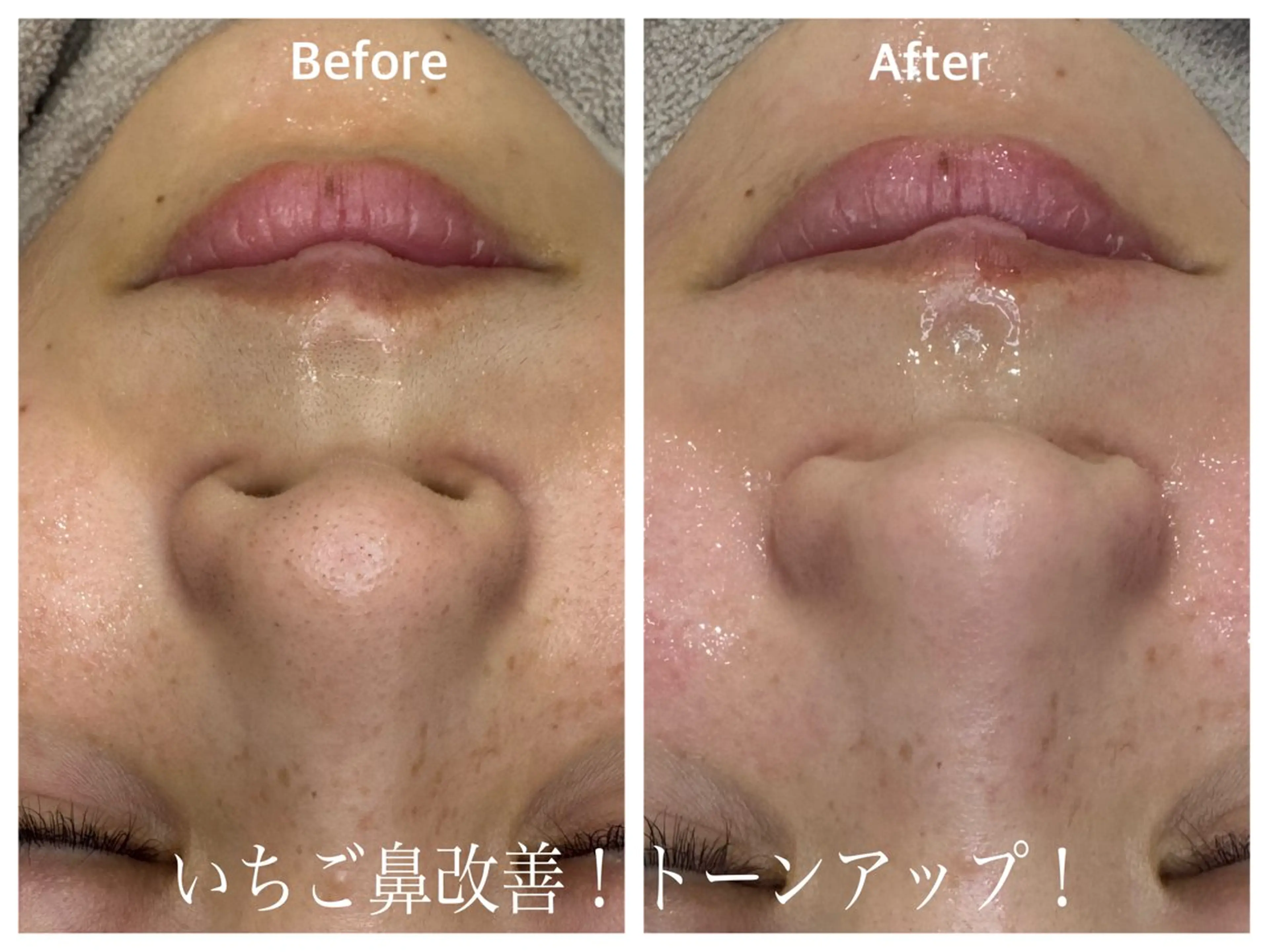 🟡毛穴に更に特化したセットメニュー【マツヤニパック✖️毛穴侍】※パッチテスト済みの方の写真