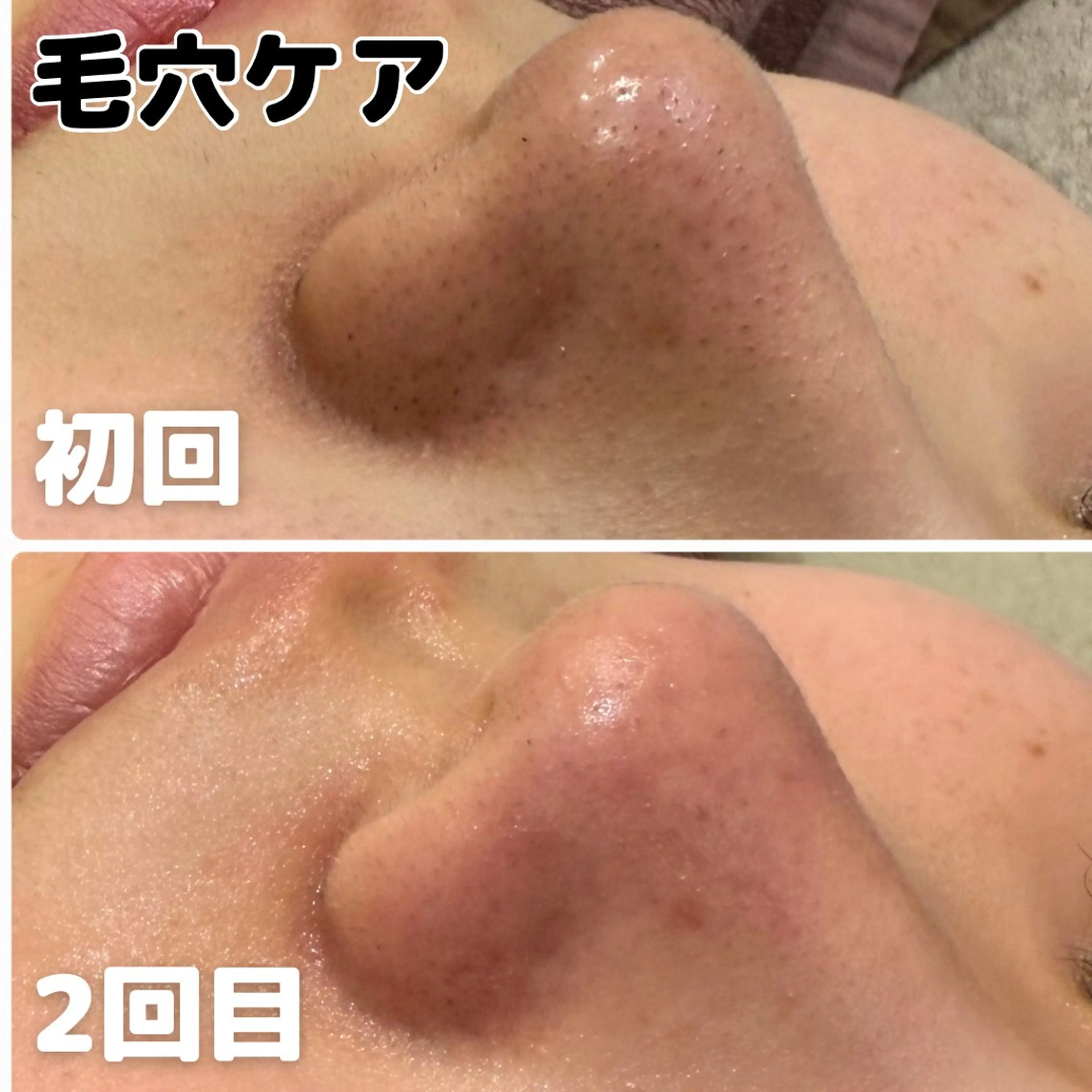 【毛穴の黒ずみ詰まりに】毛穴洗浄＋フェイシャルマッサージ＋保湿パックの写真