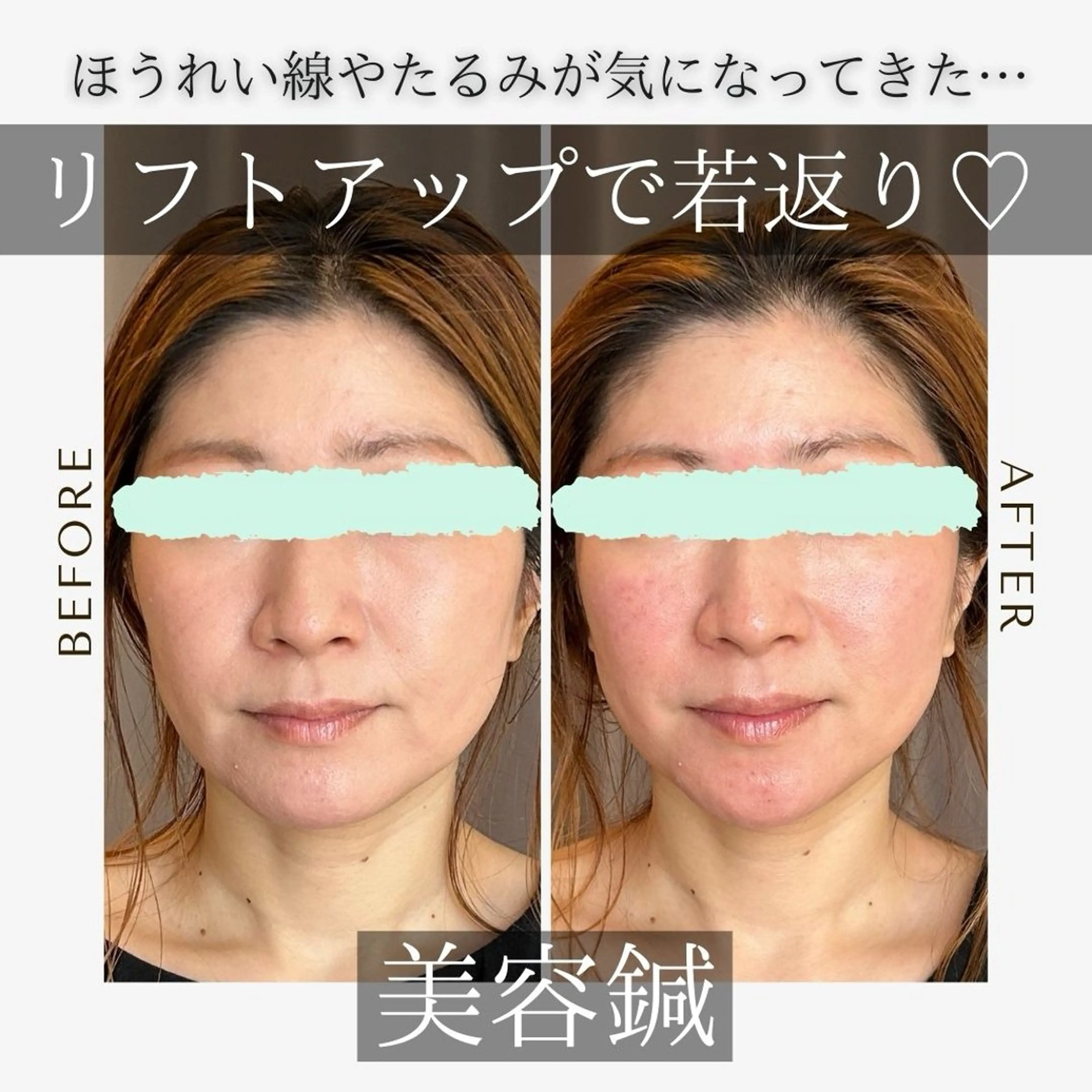 エステ リラク 《美肌･小顔》美容鍼 ＆マッサージ＊MEIのエステ・リラクイメージ