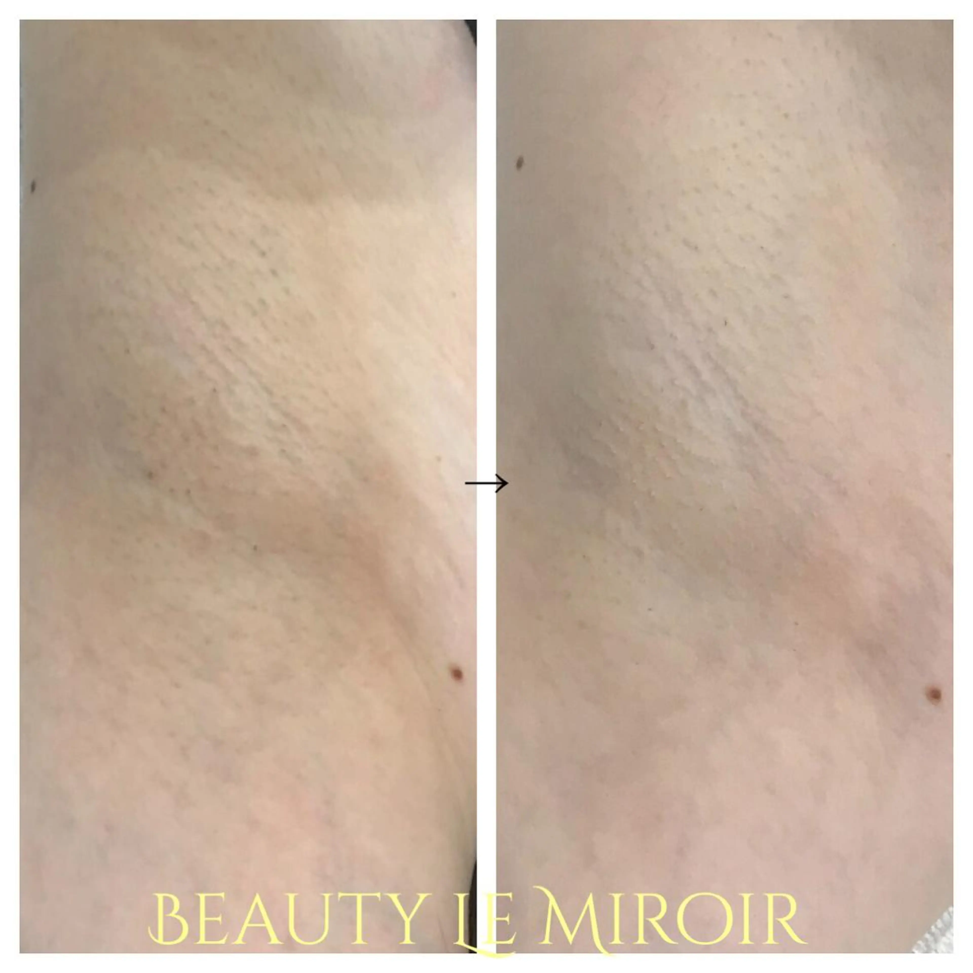 脱毛 ビューティー ミロワールのエステ・リラクイメージ