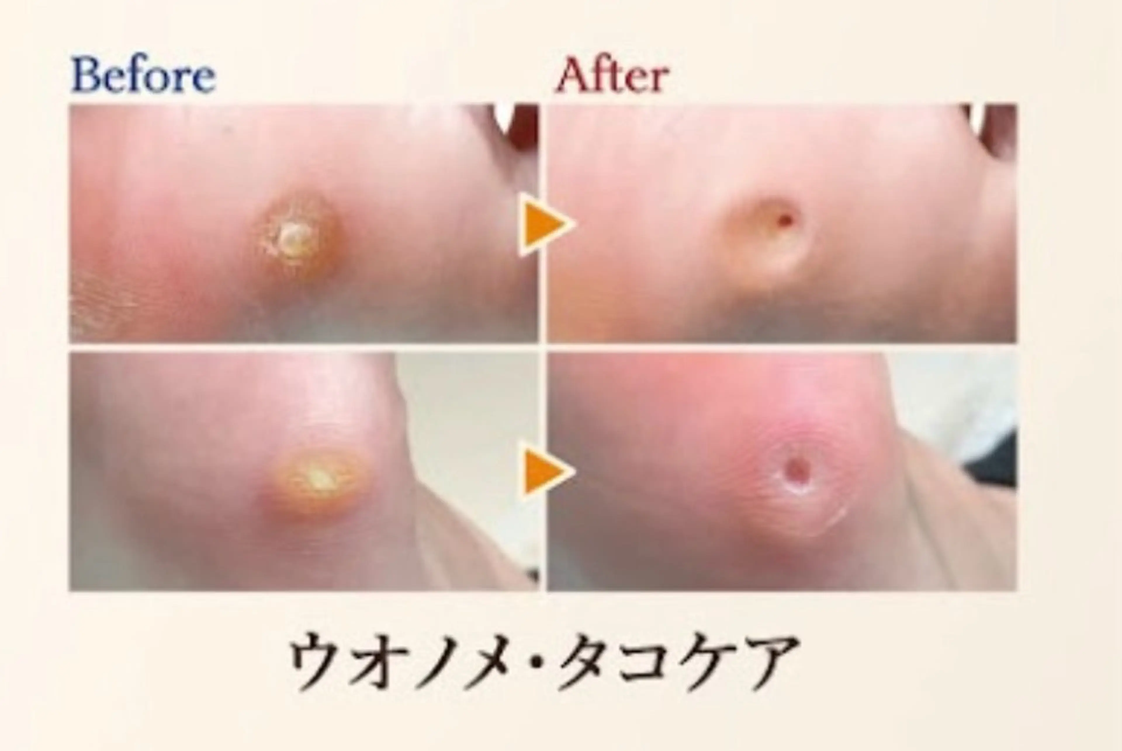 【魚の目ケア】足裏ゴワゴワ角質や痛​〜​い魚の目をキレイに取り除きスベスベの足裏へ✨の写真