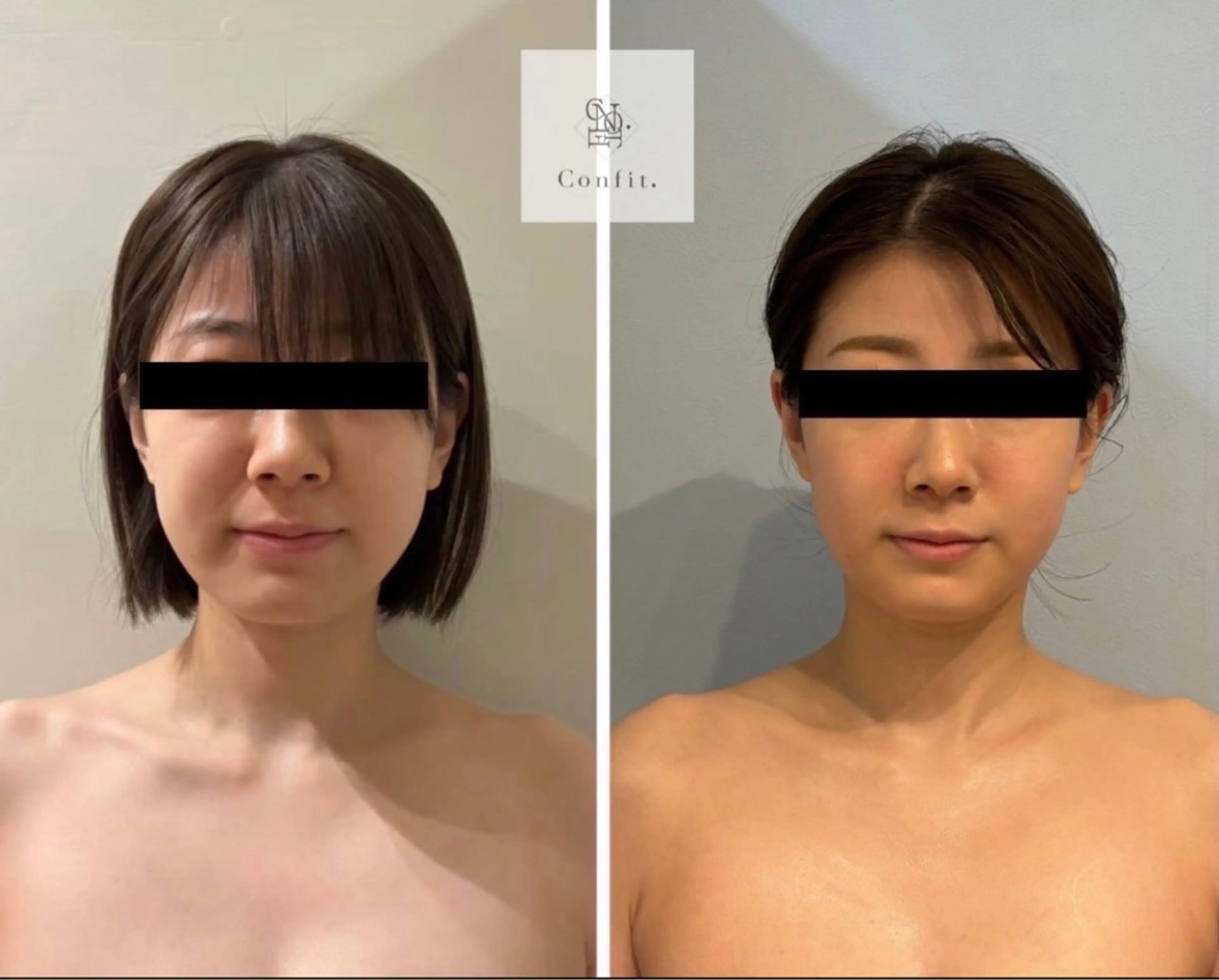 💠小顔人気No,2【小顔造顔】針を使わない【脂肪コントロール剤】導入 5ml×小顔リンパマッサージの写真