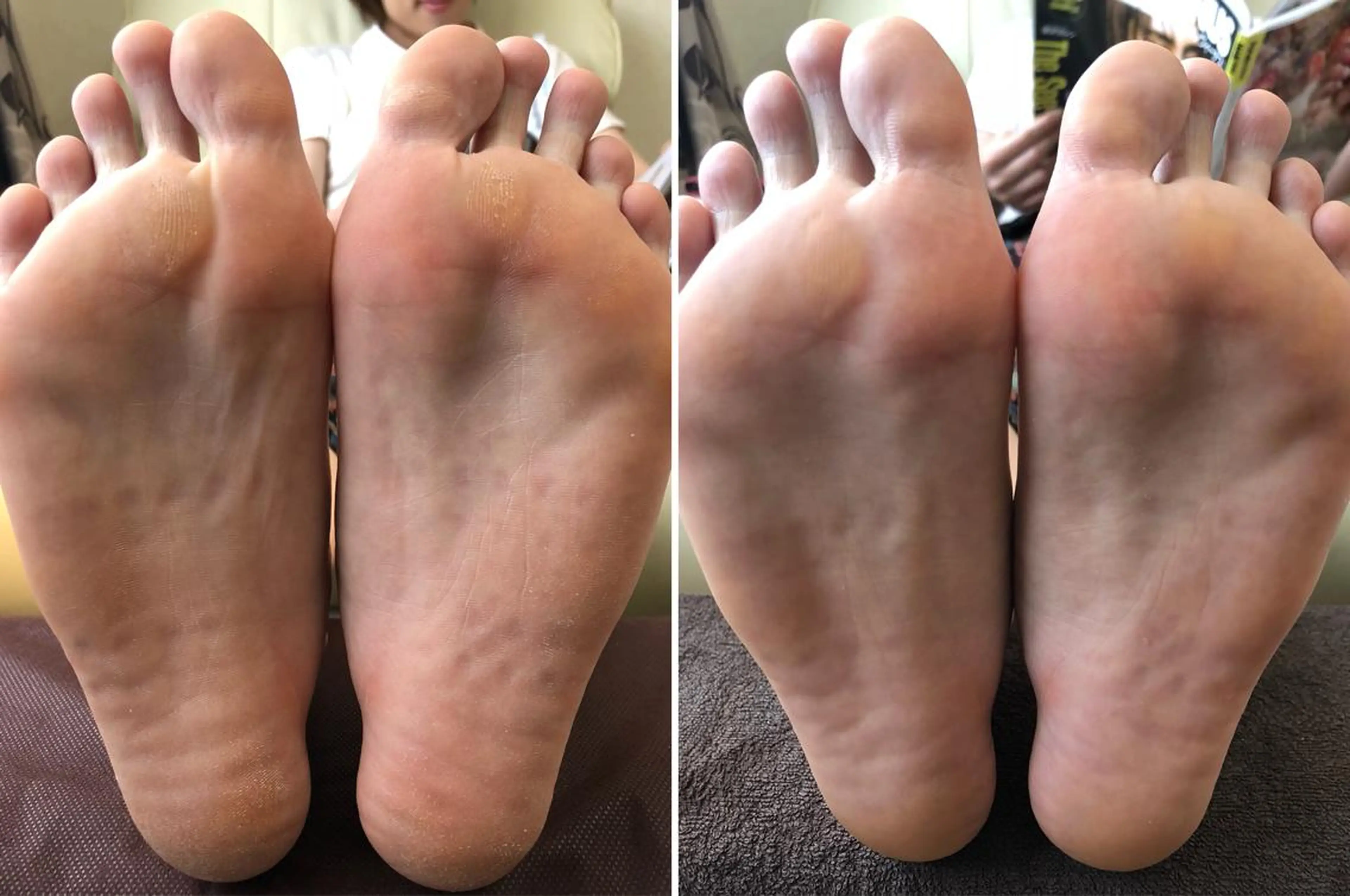 スパルーチェ(足裏角質)の写真