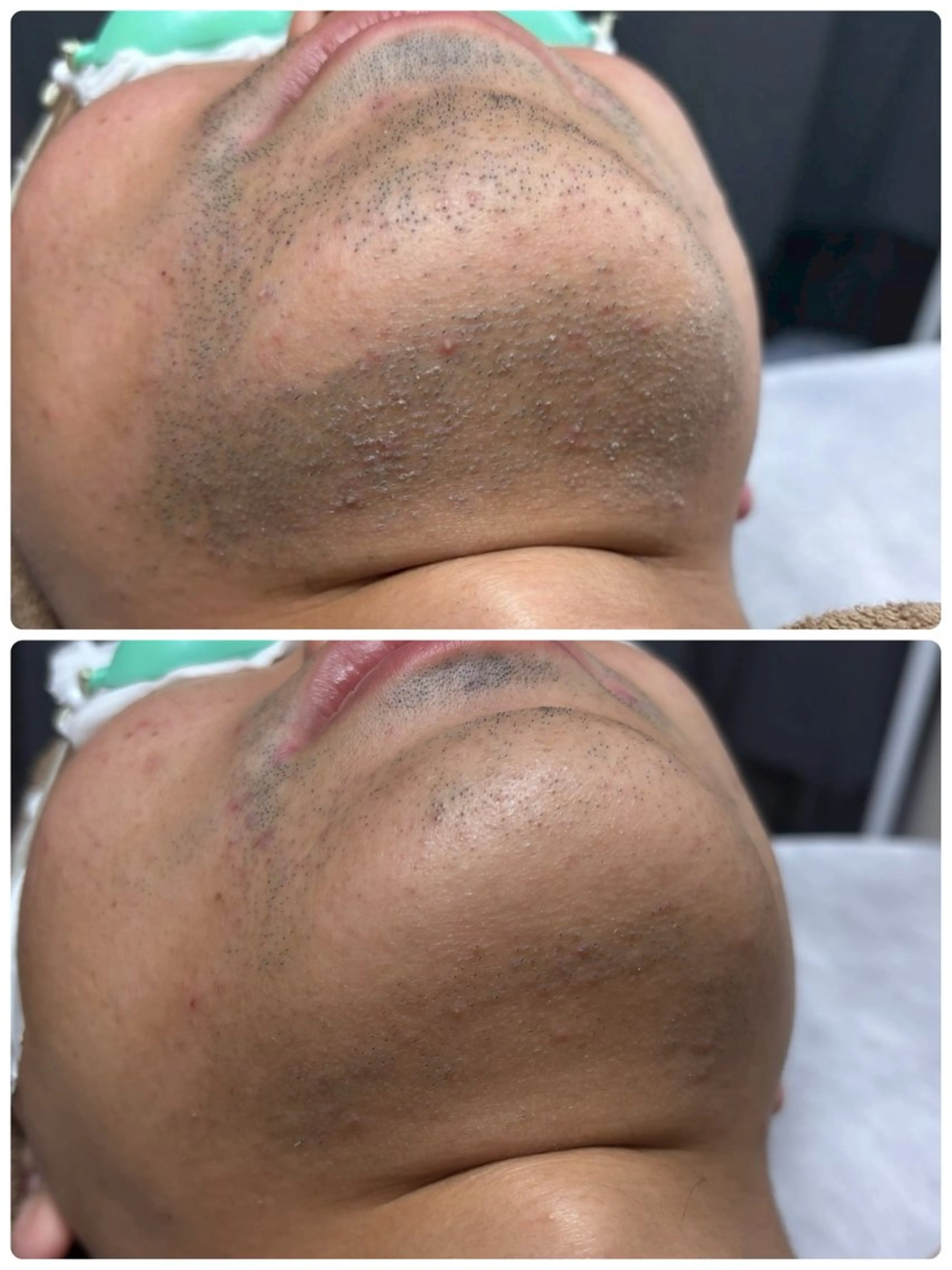 脱毛 脱毛/BBL/SHR PBSサロンAirのエステ・リラクイメージ