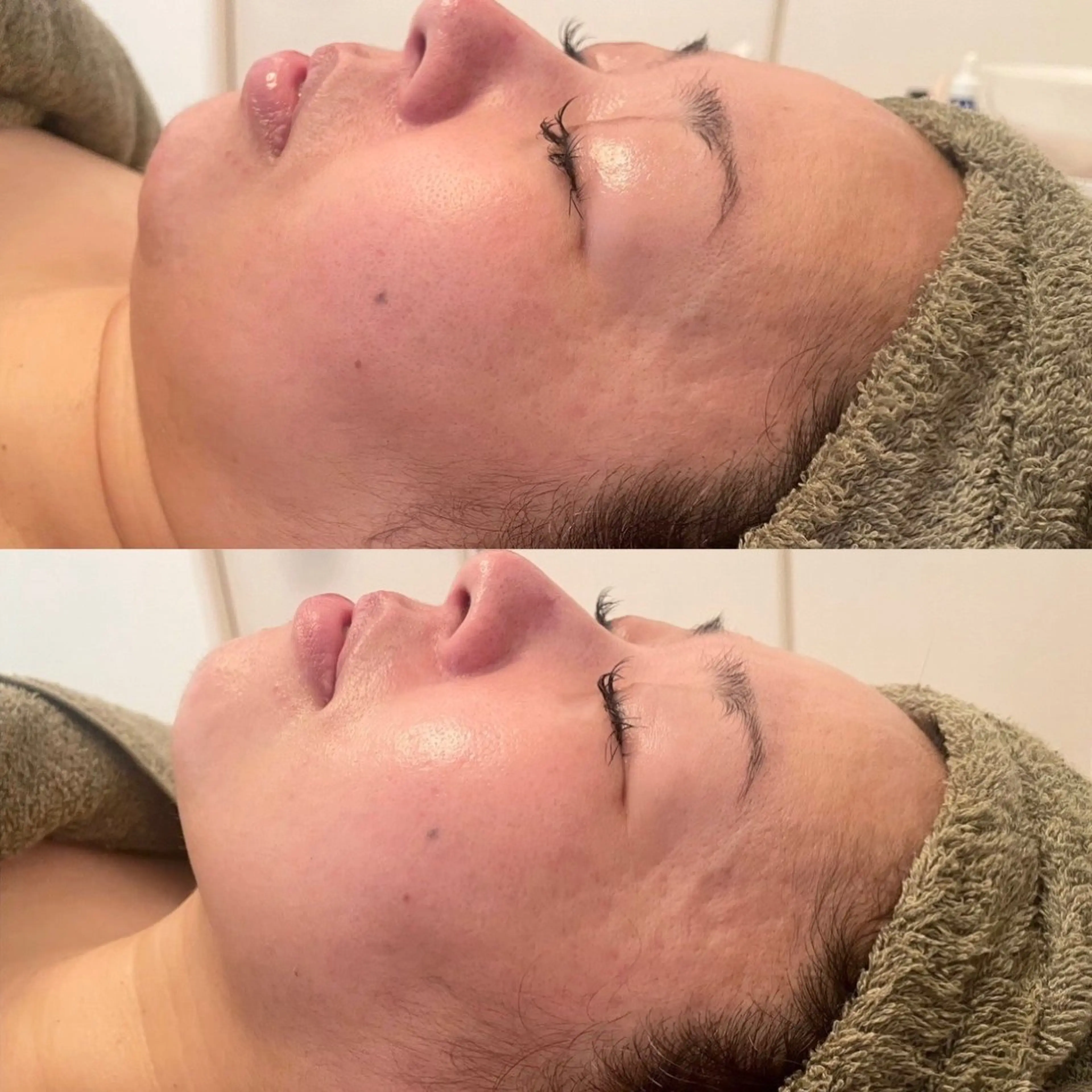 エステ リラク ニキビ・毛穴改善 🌿ハーブピーリングのエステ・リラクイメージ