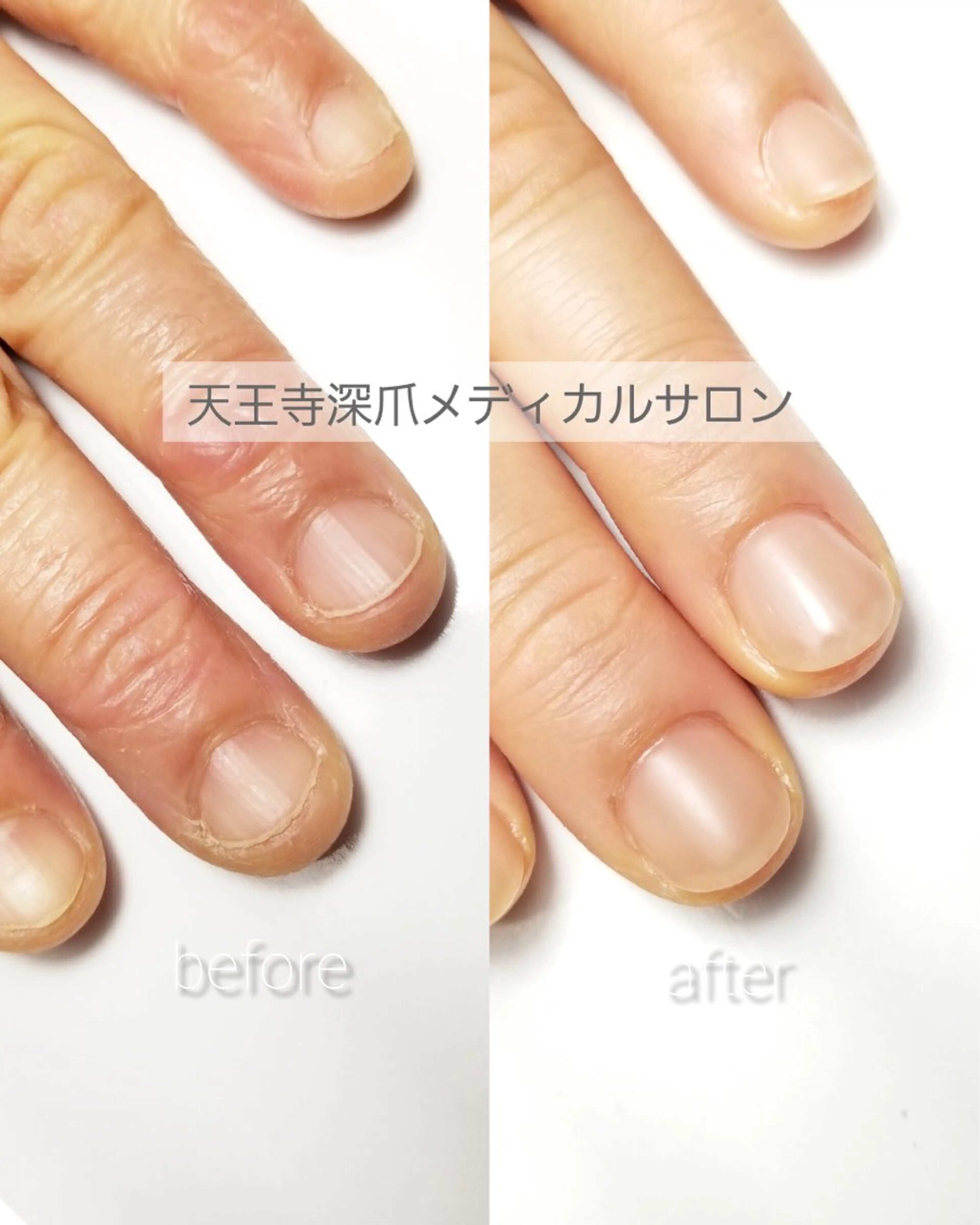 ネイル ハンドネイル ハンドケア 天王寺 深爪メディカルサロンのネイルデザイン