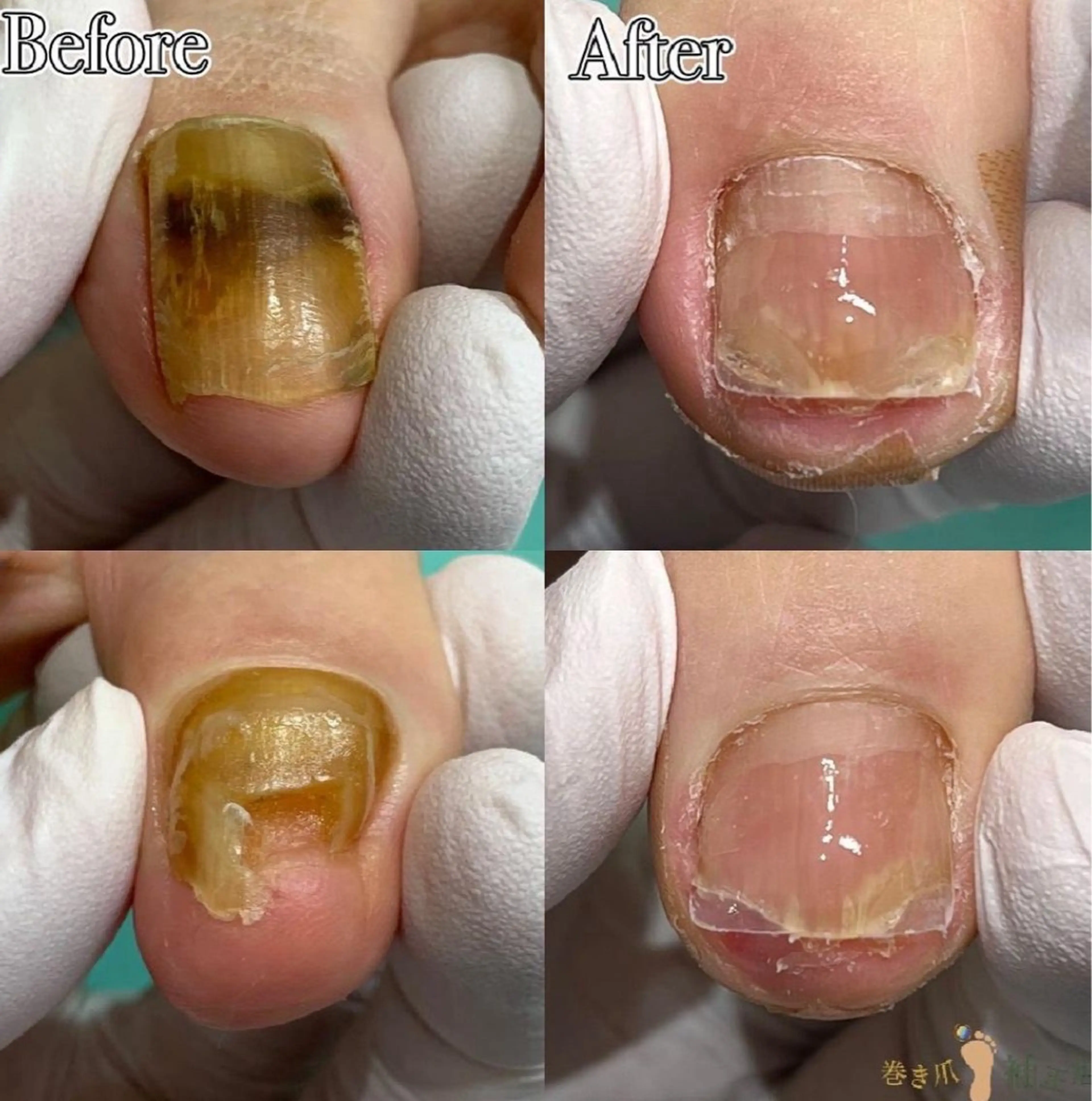 【分厚い爪・深爪再生補正】朗報✨【🉐2回目以降もずっと"施術料が500円🉐】 隠したくなる爪正常な爪へ💁♀️ ✨の写真