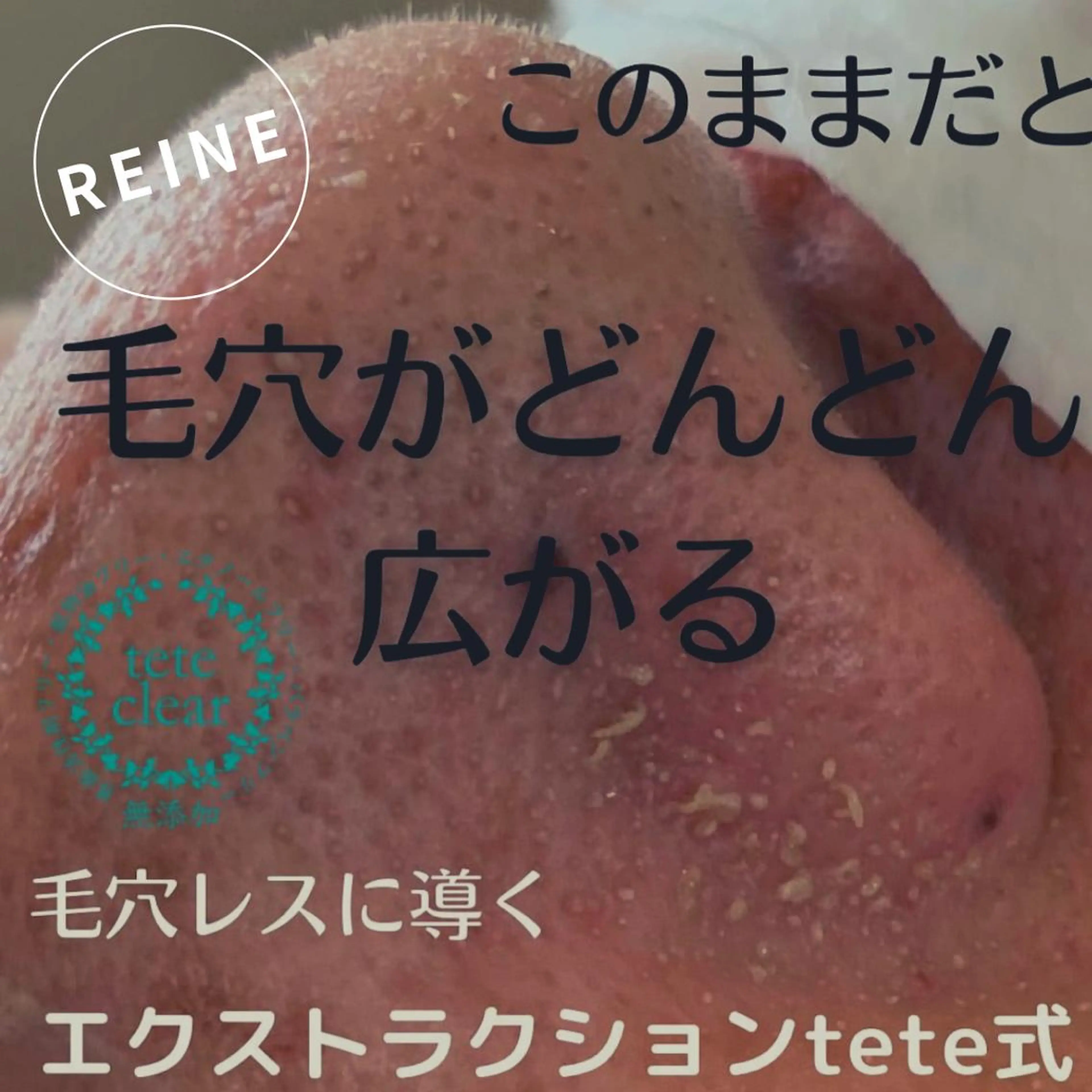 毛穴/シミ肝斑/脱毛 横山梨里のエステ・リラクイメージ