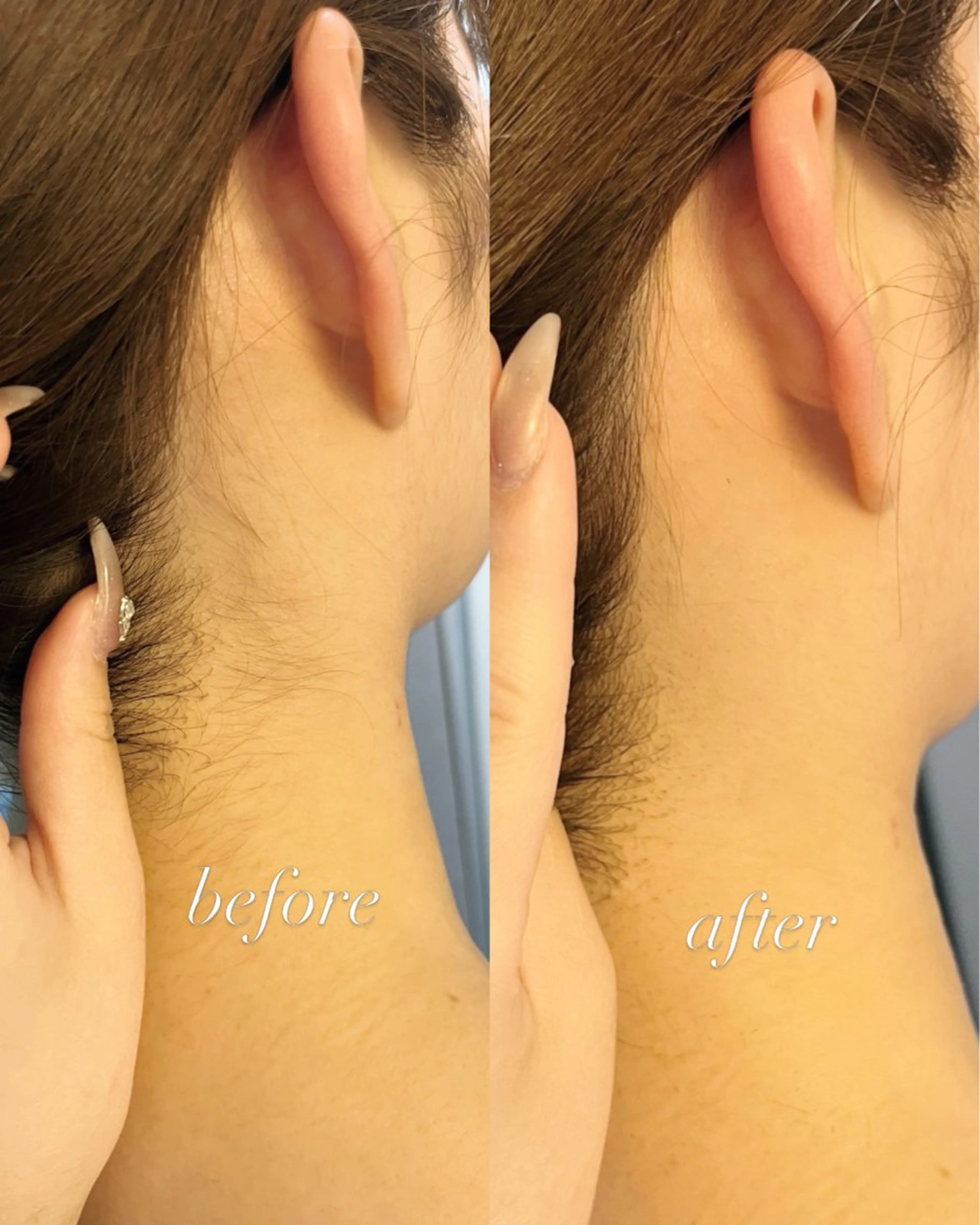 脱毛 うなじ脱毛/美肌脱毛 LABELのエステ・リラクイメージ