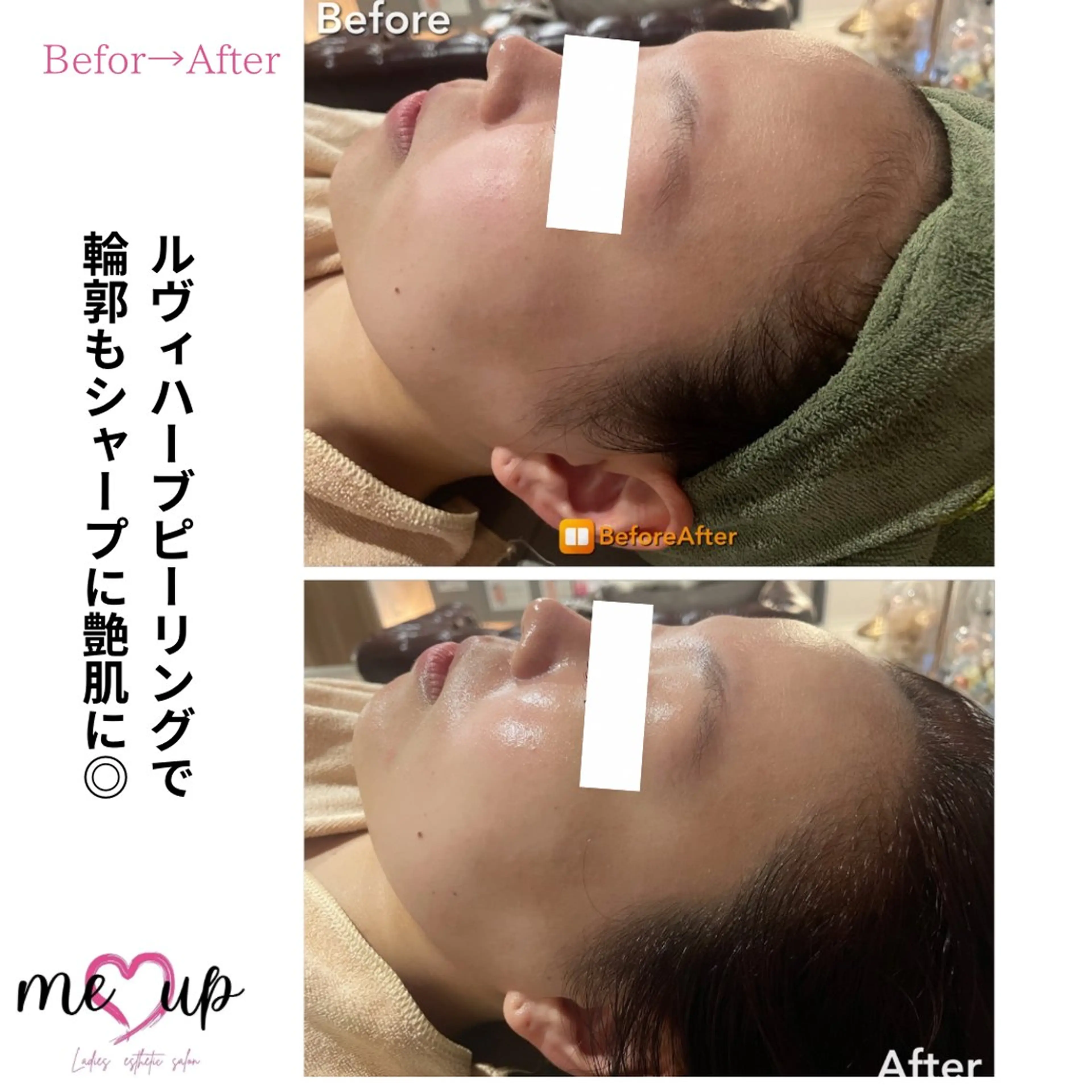 エステ Meupニキビ専門店 背中/ハーブ/肌管理のその他イメージ