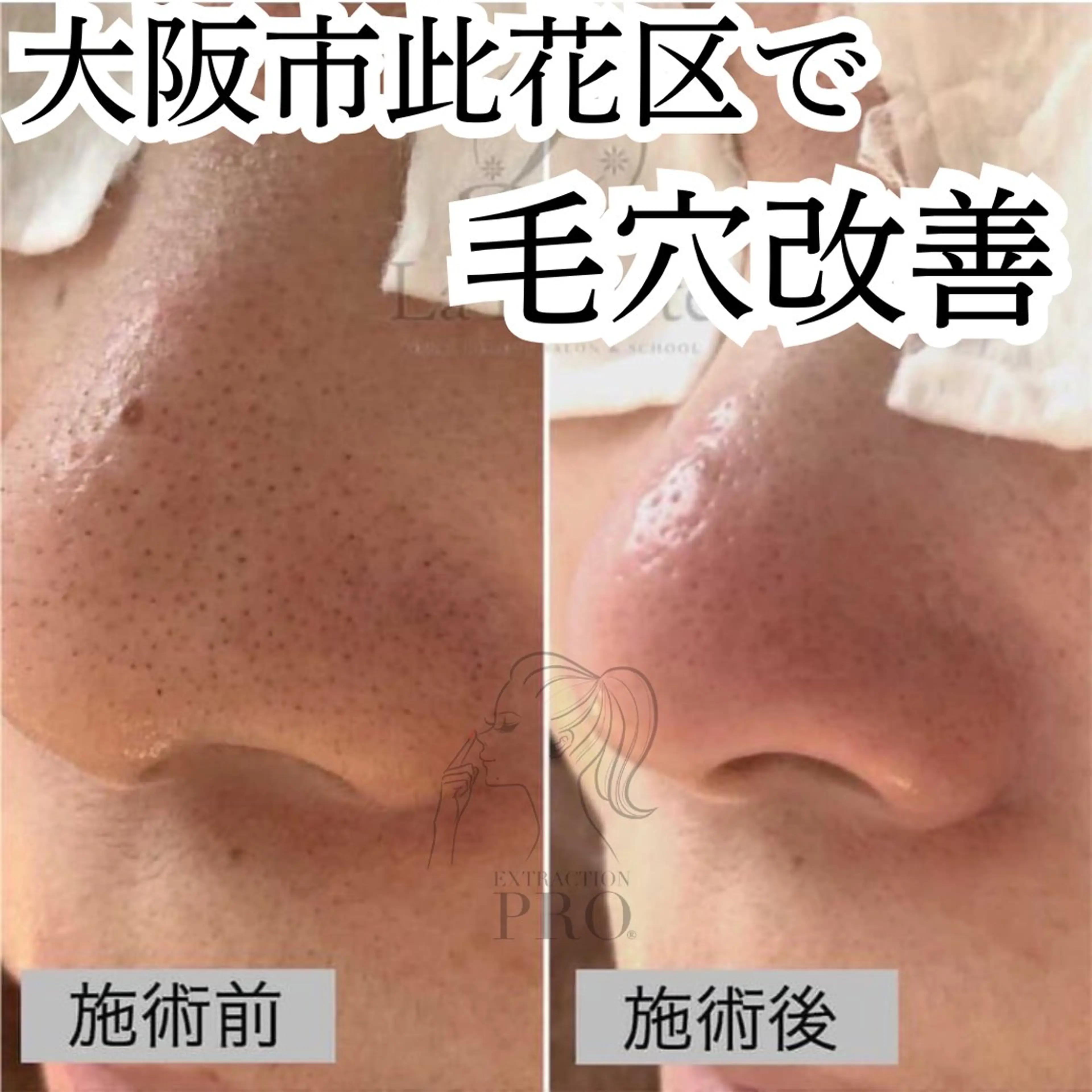 【ミニモ限定】毛穴ごっそり洗浄コース 通常12,000円→8,800円の写真