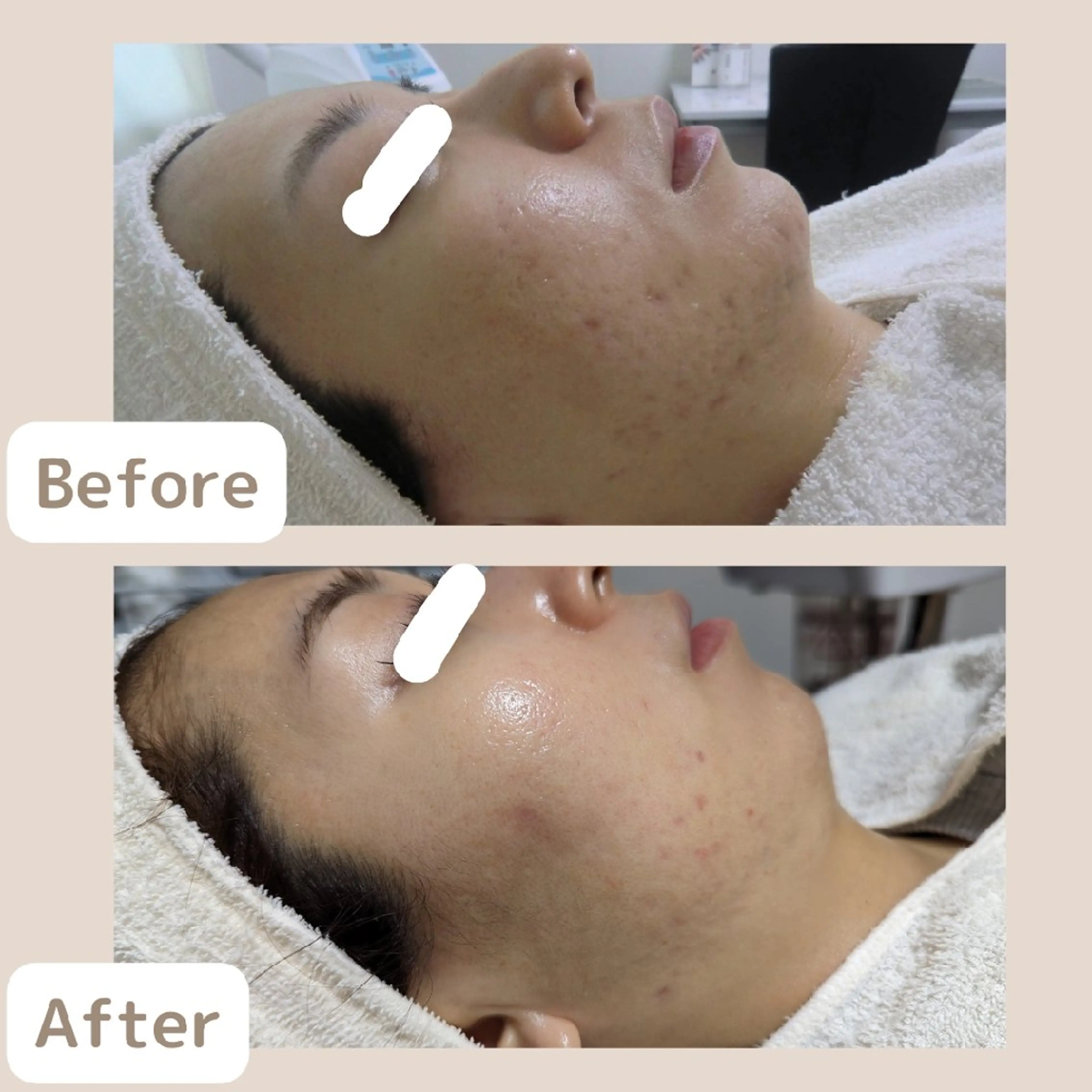 メンズ 〈ニキビケアサロン〉 レゾン京橋店/ 浅川のエステ・リラクイメージ