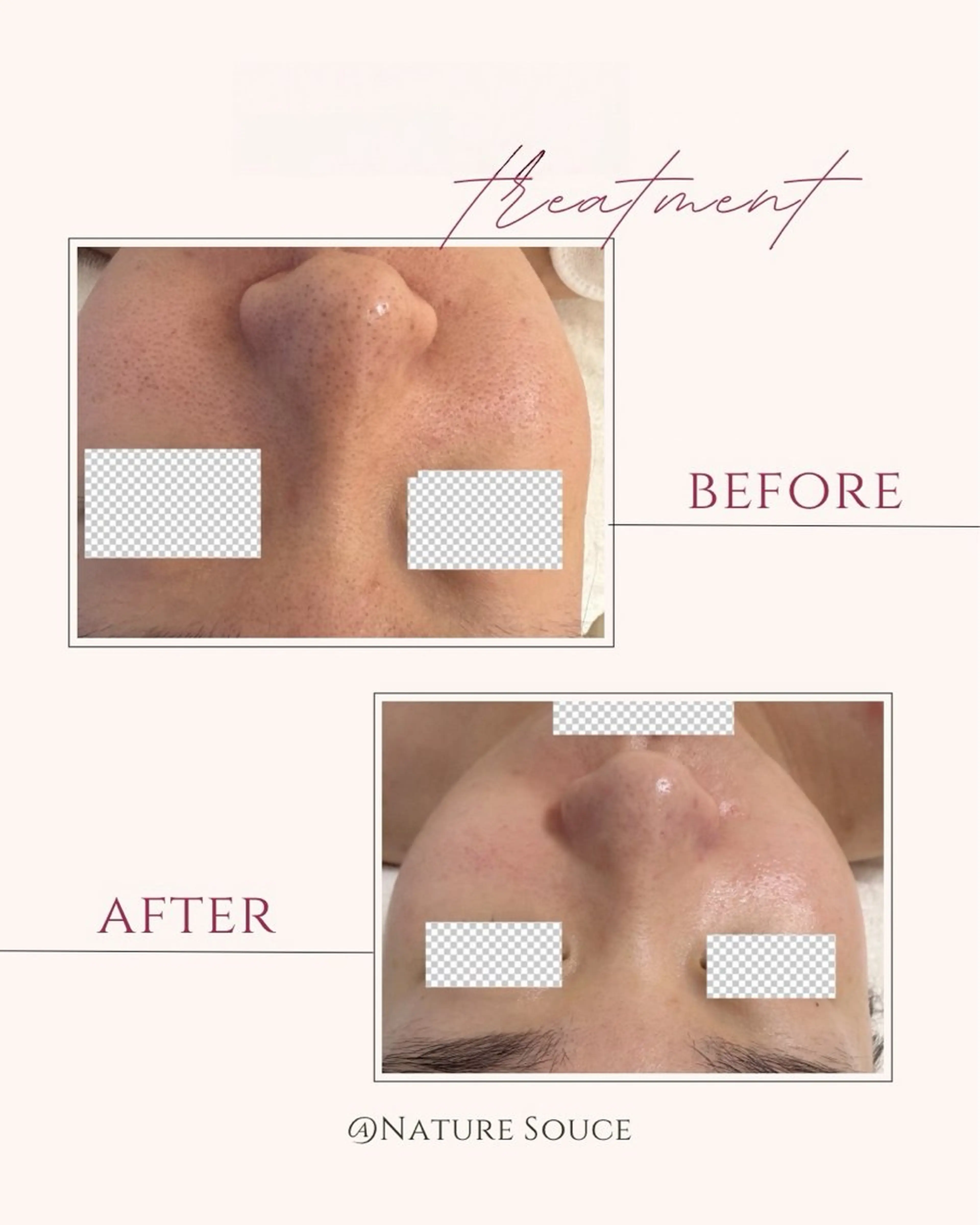 その他 Nature Souce毛穴専門店のその他イメージ