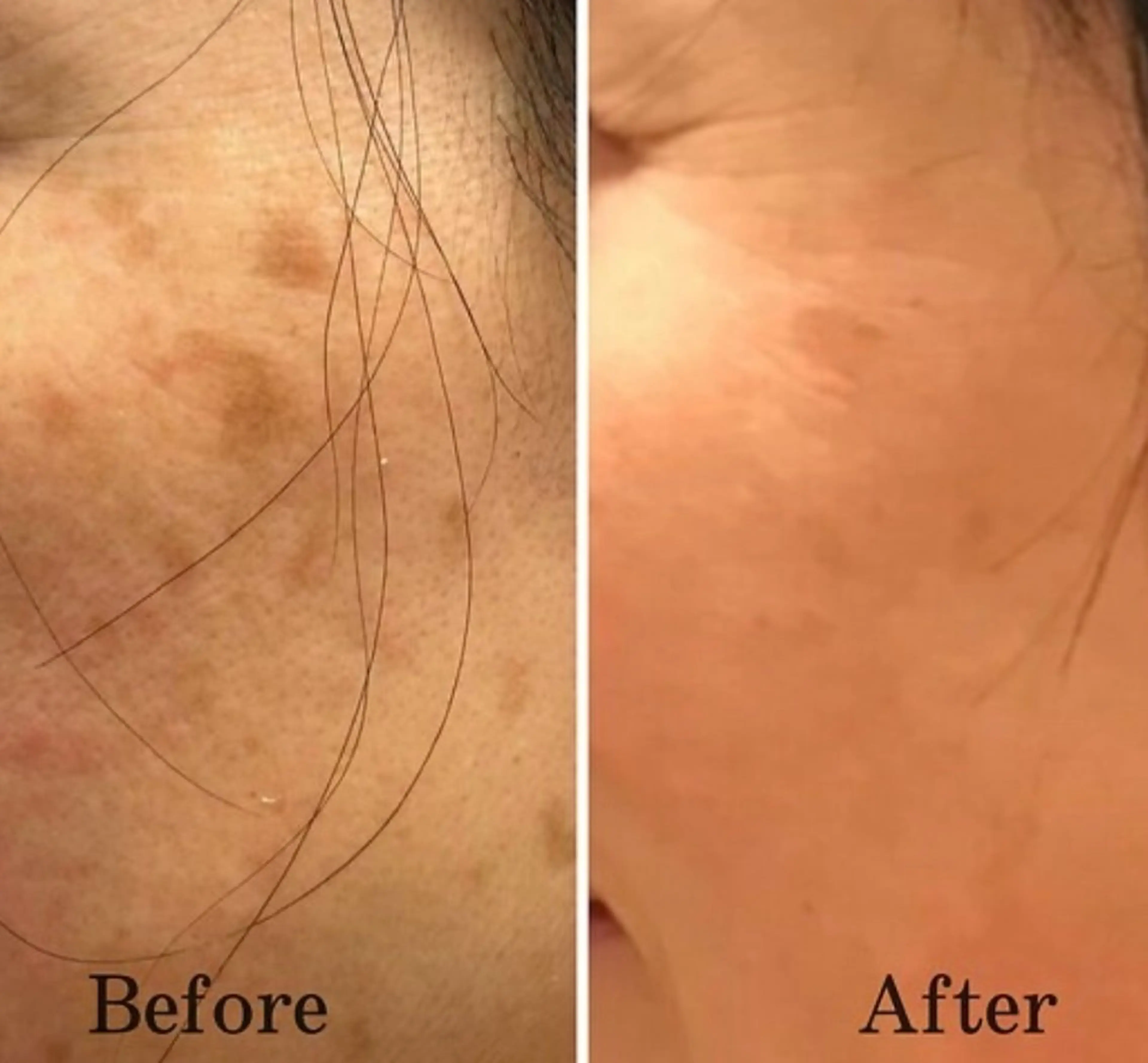 【目の下の斑点にも◎】全てのシミケアし放題の写真