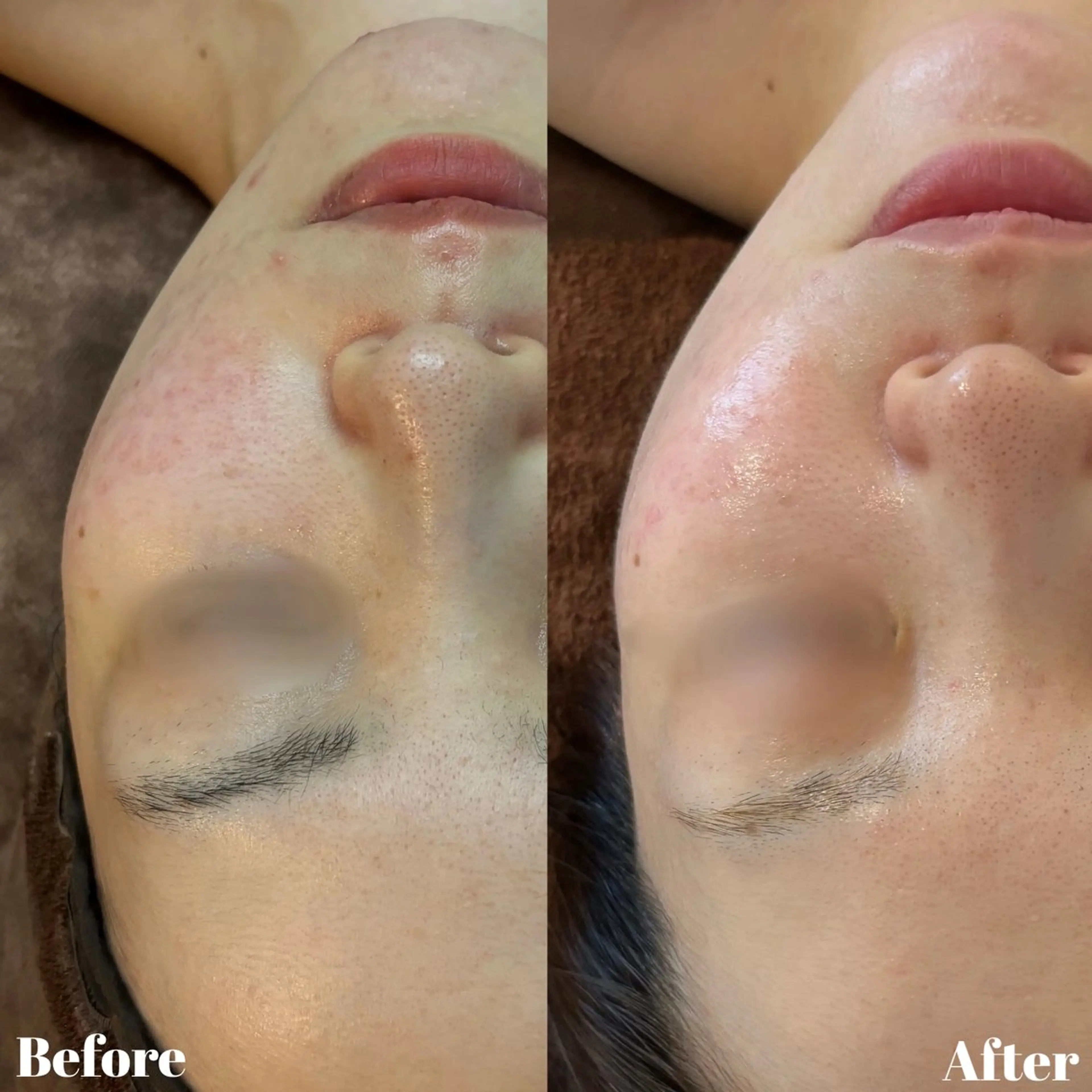 【美白・トーンアップ◎】REVIハーブピーリングの写真