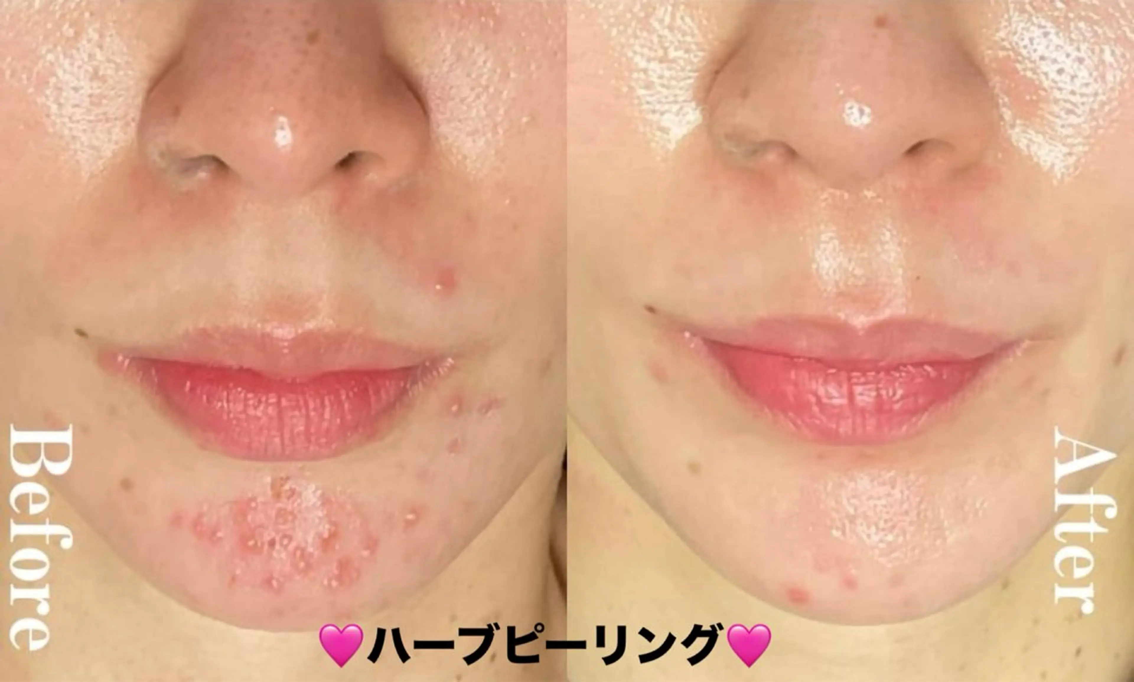 エステ ハーブピーリング専門 毛穴洗浄❤️眉waxのエステ・リラクイメージ