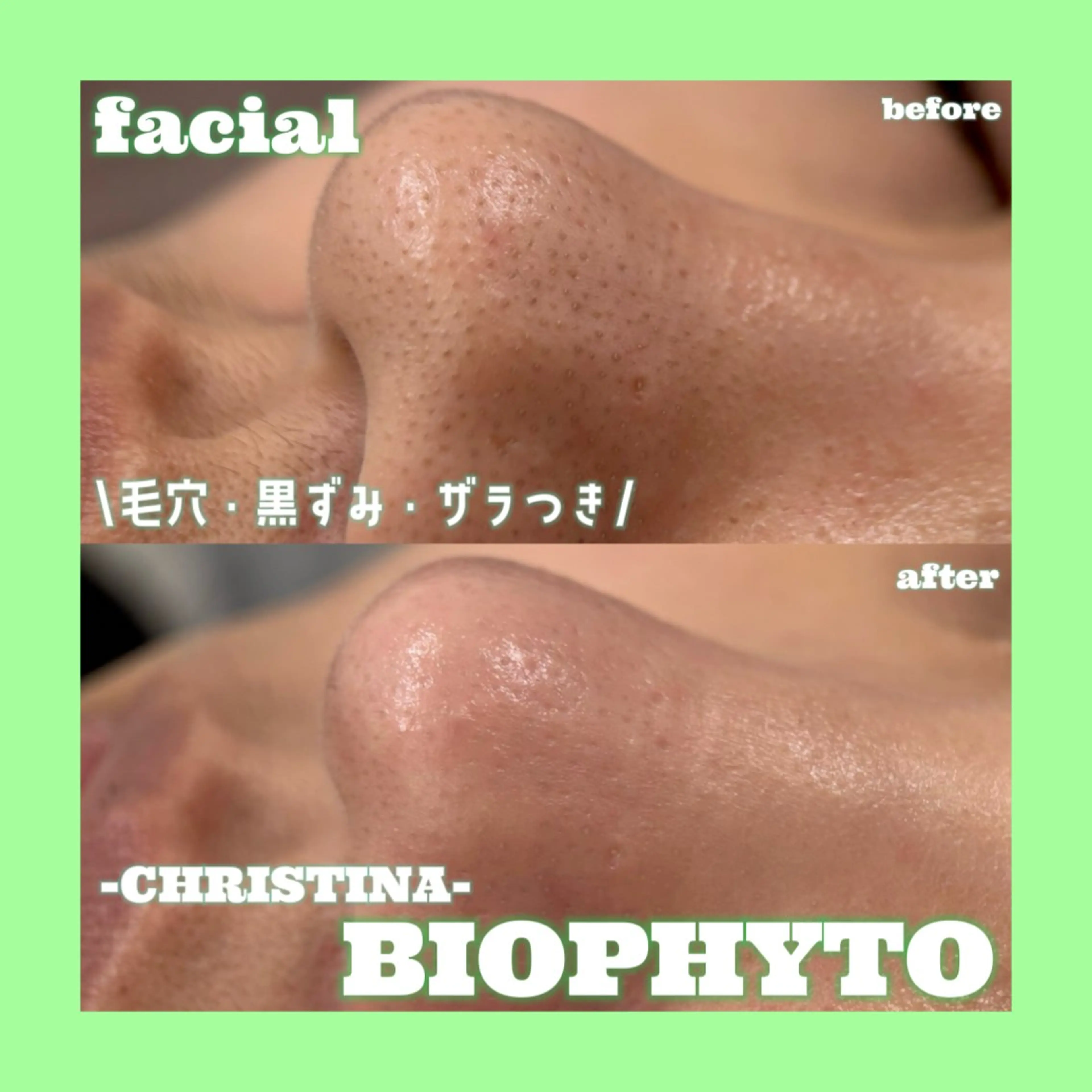 【毛穴のつまり・黒ずみ🫧】ダウンタイム無しハーブピーリング🌿変化即実感🔥つるんとタマゴ肌✨️の写真