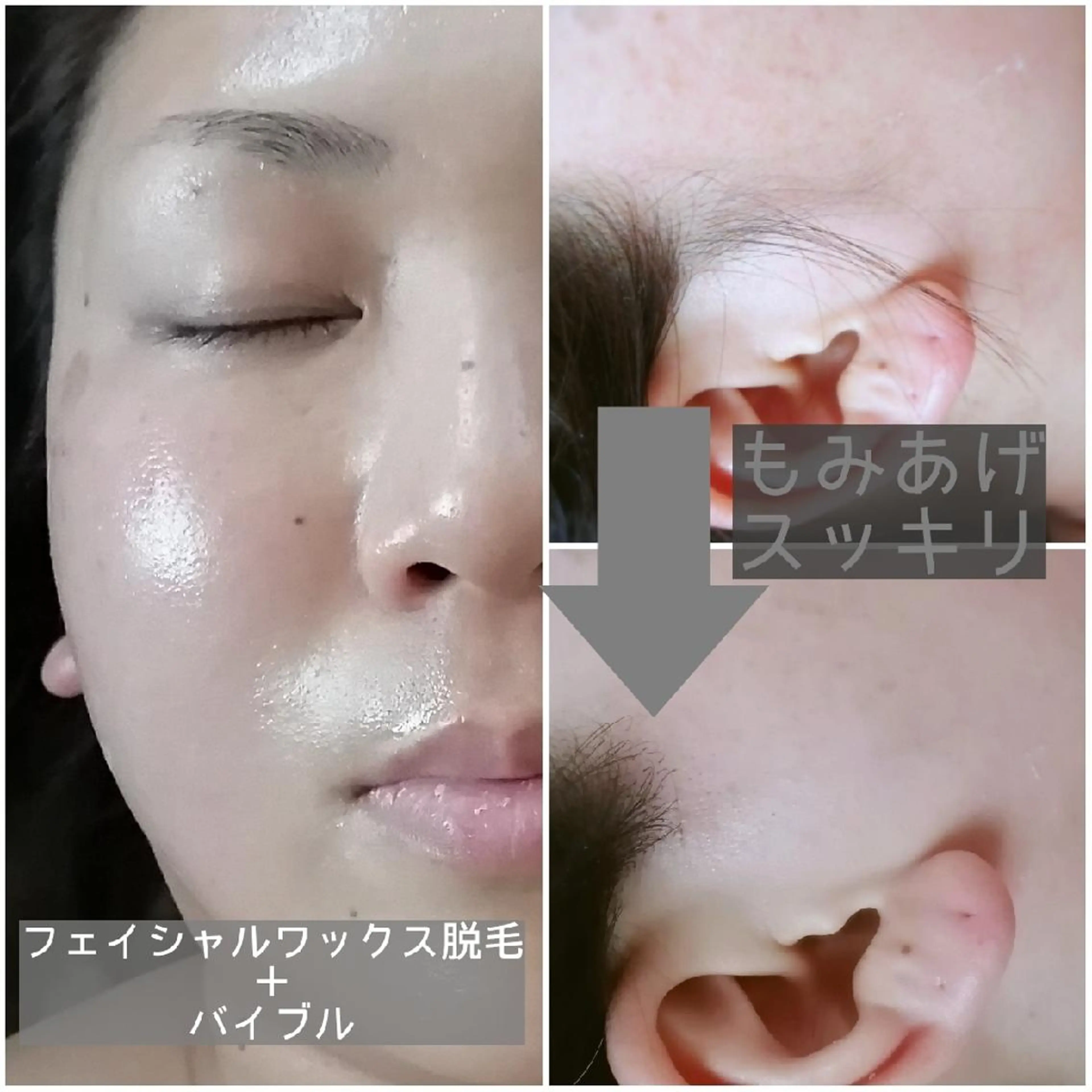 フェイシャルワックス脱毛の写真