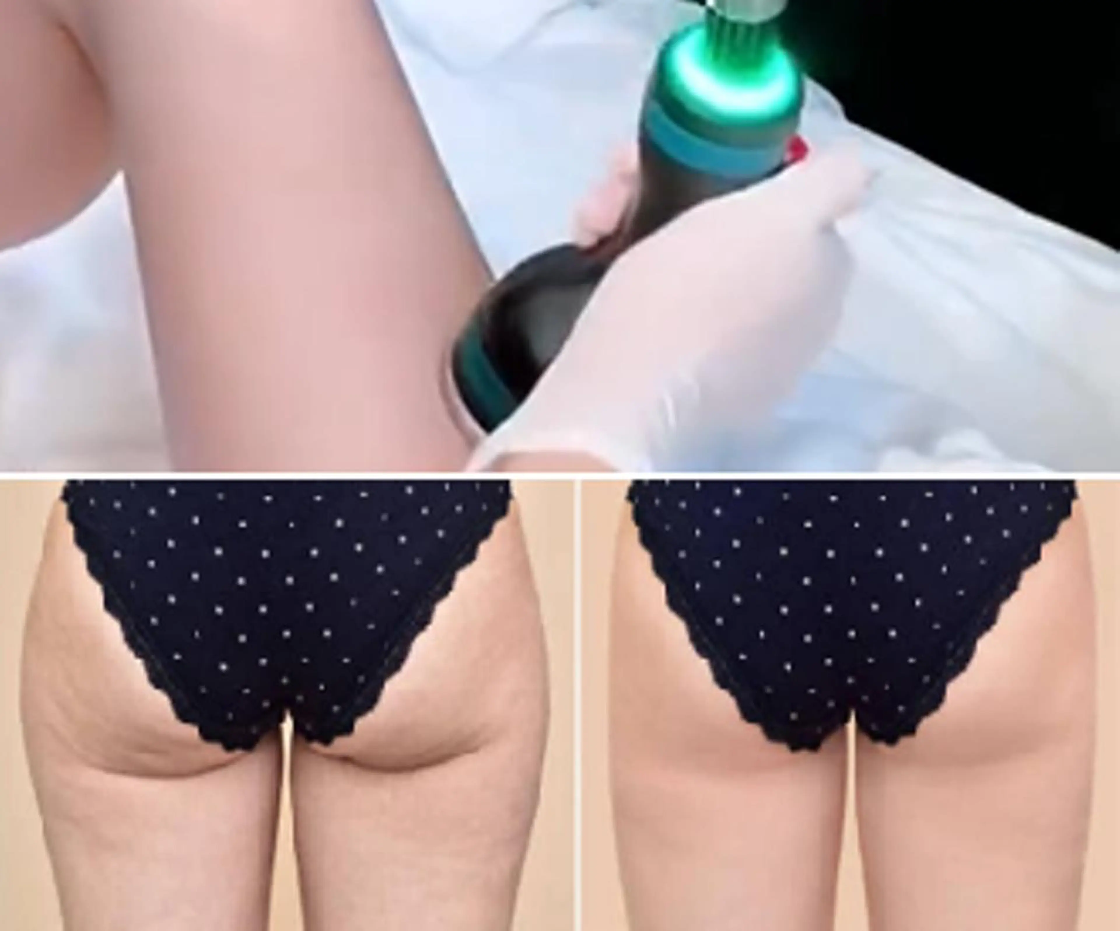 【痩身】オンダボディ：下半身痩せの救世主！痩身はもう冷却脂肪の次の時代 ※2箇所の写真