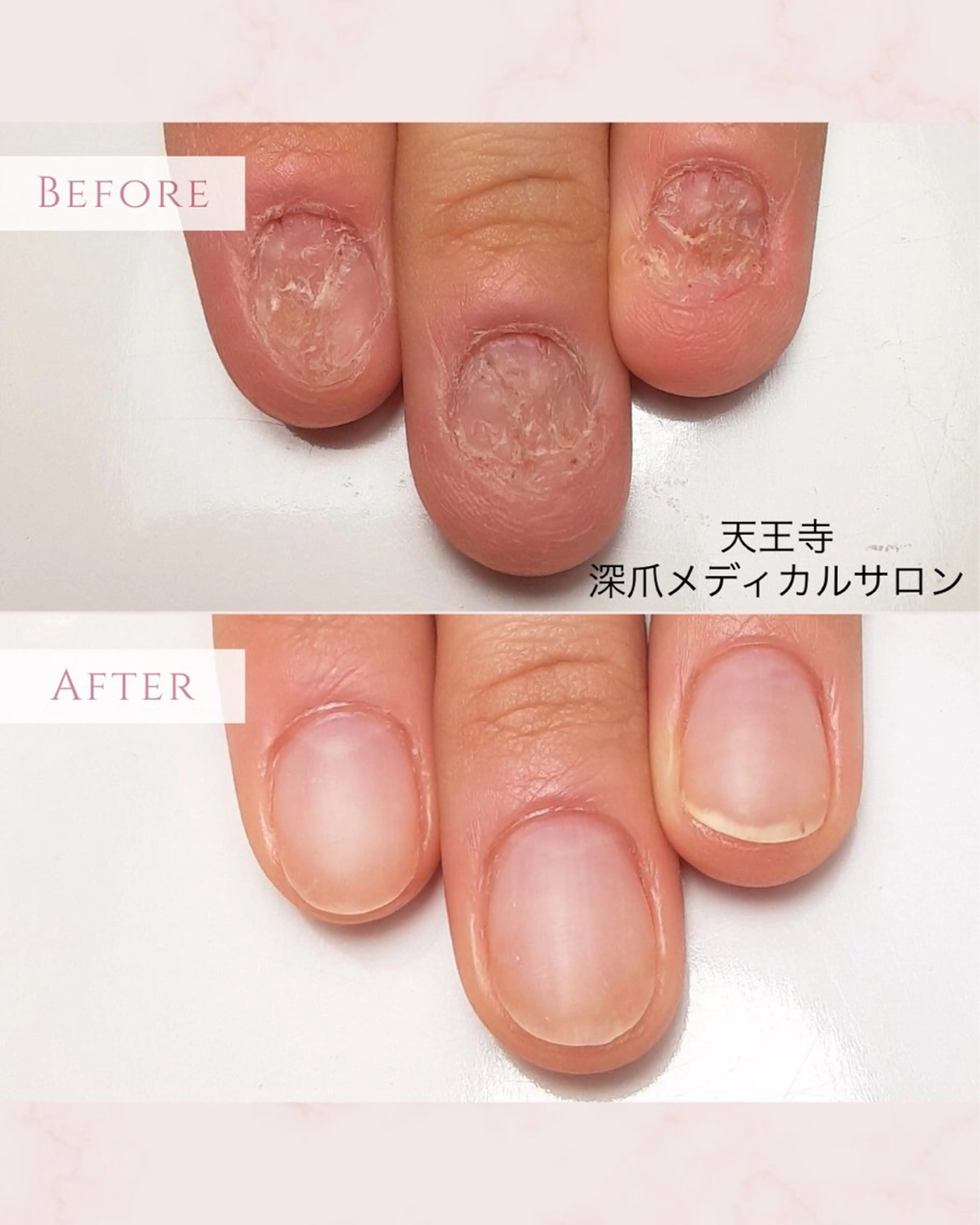 ネイル 天王寺 深爪メディカルサロンのネイルデザイン