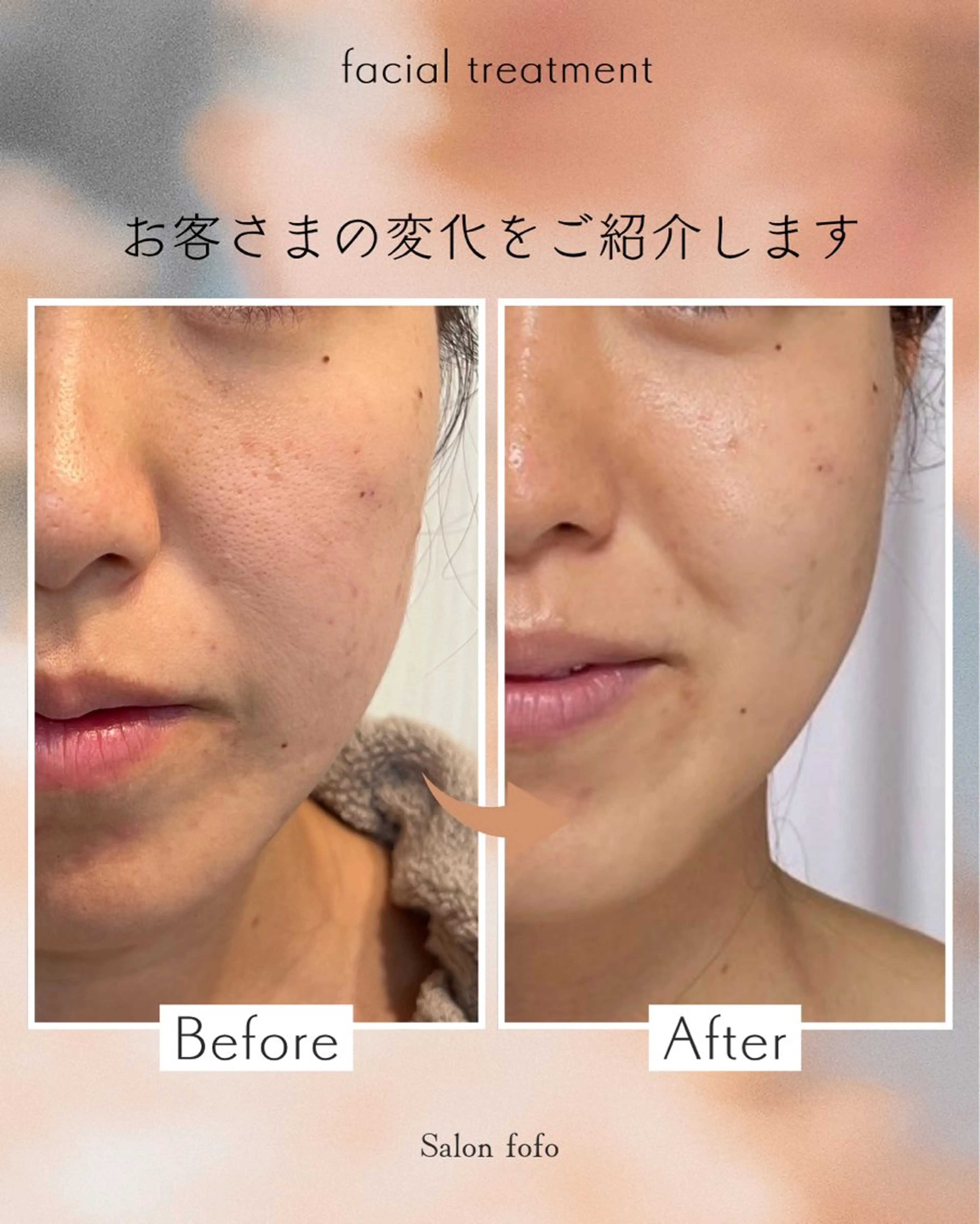 フェイシャルエステの写真